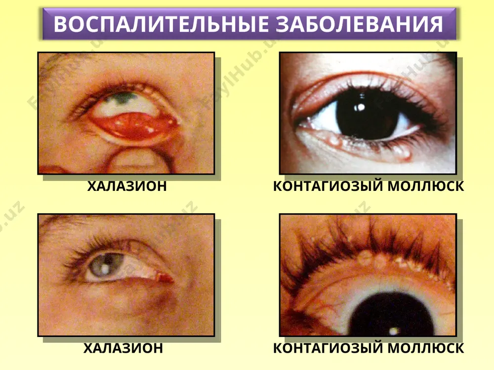 zabolevaniya pridatkov glaza, rogovichy i sklery - Page 4