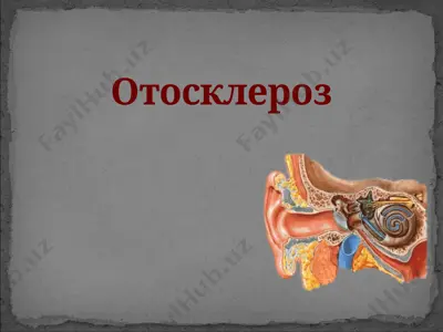отосклероз — PPTX