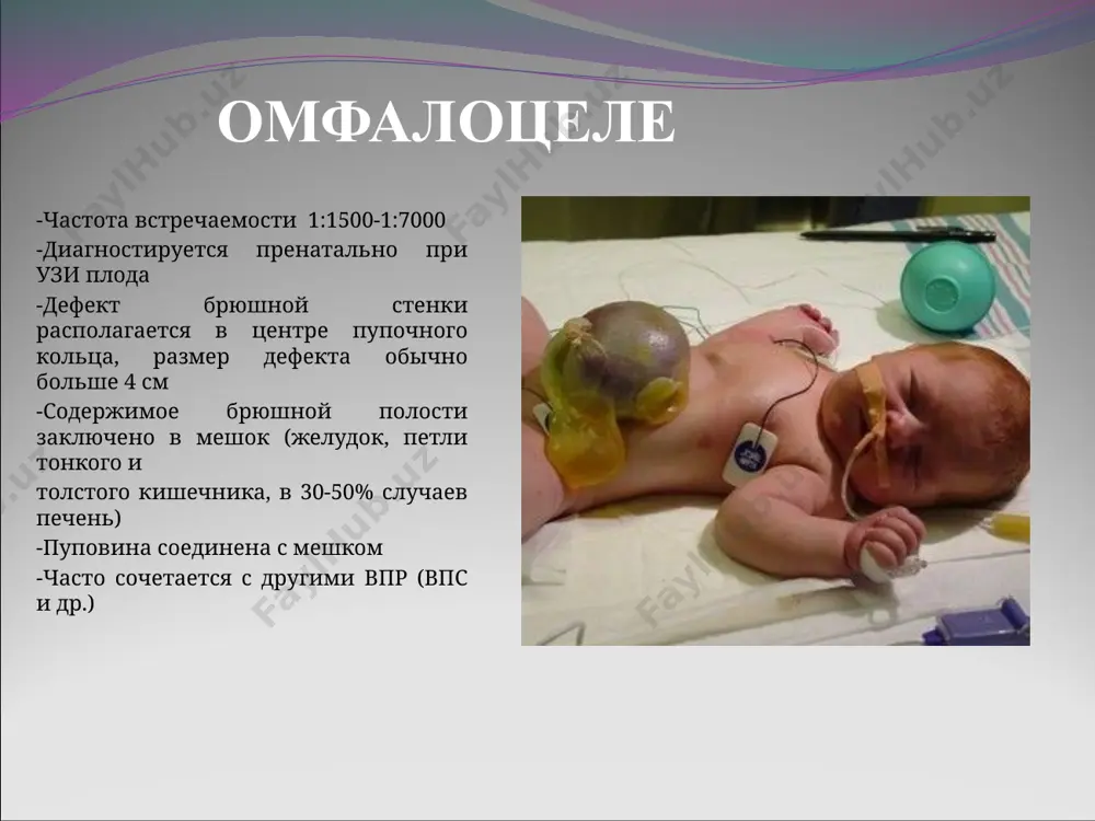 варианты коррекции -оптимальная тактика лечения –одноэтапная коррекция порока в течение 1-3 дня жизни (перевязка тпс, прямой анастомоз между проксимальным и дистальными концами пищевода) - в ряде случаев (большой диастаз между концами пищевода) –паллиативная операция с выведением эзофагостомы и гастростомы, радикальная коррекция в отсроченном периоде(эзофагоколонопластика) - гастростомия–паллиативная операция у детей с серьезными сопутствующими аномалиями или сепсисом крестцово-копчиковая тератома - частота встречаемости 1:40000 рожденных детей наиболее часто встречающееся новообразование у новорожден-ных детей, - 95% девочки - от 2 до 10% тератом становят- ся злокачественными на первом месяце жизни, 50%- на первом году жизни врождённый пилоростеноз -этиология заболевания до конца неизвестна - мальчики болеют в 4 раза чаще девочек - основной клинический признак –рвота «фонтаном» без примесей желчи на 3-4 неделе жизни, после рвоты ребенок требует молоко - в ряде случаев пилоростеноз можно пропальпи -ровать узи брюшной полости подтверждает диагноз (если толщина мышечного слоя привратника более 4 мм) -быстро развивается дегидратация, гипокалиемия, метаболический …