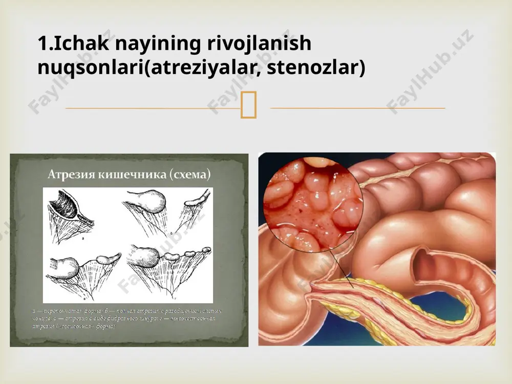 ontal sathli suyuqlik aniqlanadi – kloyber kosachalari aniqlanadi. tutilish qancha pastda bo’lsa suyuqlik sathi shuncha ko’p bo’ladi. girshprung kasalligidan farqlash maqsadida irrigografiya o’tkaziladi. bunda butun yo’g’on ichak bilan torayish ya’ni mikrokolon simptomi bo’ladi. diagnostika  ichak tutilishiing har qanday joylashuvida operativ kesim bir xil – laparotomiya, zarur holatlarda chandiqlarni kesib, olib tashlash, yopishgan ichaklarni asta-sekin ajratish. operativ davolash  asoratlanmagan formasida och va yonbosh tug’ma ichak tutilishlarida, t-simon yengillashtiruvchi anastamoz qo’yish maqsadga muvofiq. operatsiya ichak qorin oldi devoriga stoma ko’rinishda chiqrish bilan tugallanadi. bunda bir qatorli ichak choki qo’yiladi. operatsiya vaqtida stoma orqali anastamozdan 2 ta naycha o’tkaziladi, keyinroq proksimal segmentga, ingichkasi distal segmentga qo’yiladi. bunday ulash usuli ichaklar o’rtasida keng teshik hosil qilib, ichak ajralmalarining to’siqsiz evakuatsiya bo’lishini ta’minlaydi. operatsiyadan keyingi 3-sutkada enteral ovqatlantirish ichakni uzoqlashtiruvchi qismiga o’tishi tekshiriladi. mekonial ichak tutilishida bu naychalar orqali ichak ajralmalarini suyultirish maqsadida ko’p miqdorda pankreatin yuboriladi.. naychalar ichaklarda passaj tiklangan va axlat …