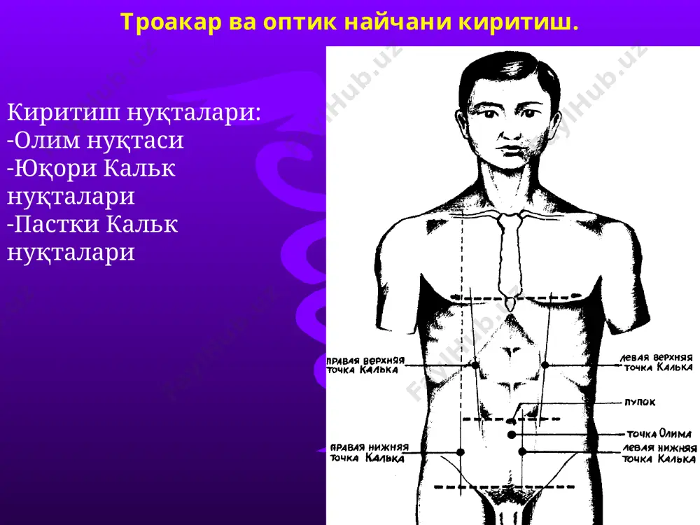 а ости бези капсуласига тикиш) а.а. шалимов бўйича 5/8 или 2/3 1/2 3/4 7/8 меъдани бильрот ii усули гофмейстер - финстерер модификациясида кесиш меъданинг олинадиган қисмини кесиб ташлаш меъда чўлтоғини тикиш босқичлари меъда чўлтоғини кичик эгрилик бўйлаб узлуксиз чок билан тикиш меъда чўлтоғига иккинчи қатор- сероз-мушак чокини қўйиш ингичка ичак қовузлоғини меъда чўлтоғига гофмейстер- финстерер усулида тикиш гофмейстер- финстерер усулида анастомозга биринчи қатор сероз-мускул чокларини қўйиш гастроэнтероанастомоз қўйиш (ичак деворини кесиб очиш) гастроэнтероанастомознинг орқа лабига узлуксиз косибча чок қўйиш) гофмейстер- финстерер усулида анастомознинг олдинги лабига айланувчи чокларини қўйиш гофмейстер- финстерер усулида анастомознинг олдинги лабига сероз-мушак чокларини қўйиш анастомоз қирғоқларини кўндаланг чамбар ичак тутқичига тикиш меъдани бильрот ii усули райхел – полиа модификациясида резекция қилиш ошқозон ва семизлик муаммоси рецепторы насыщения в желудке. слева показан пустой желудок, справа желудок, заполненный пищей желтого цвета принцип действия ограничительного кольца на желудке. слева – исходная схема, справа – вид после операции схема вертикальной гастропластики. …