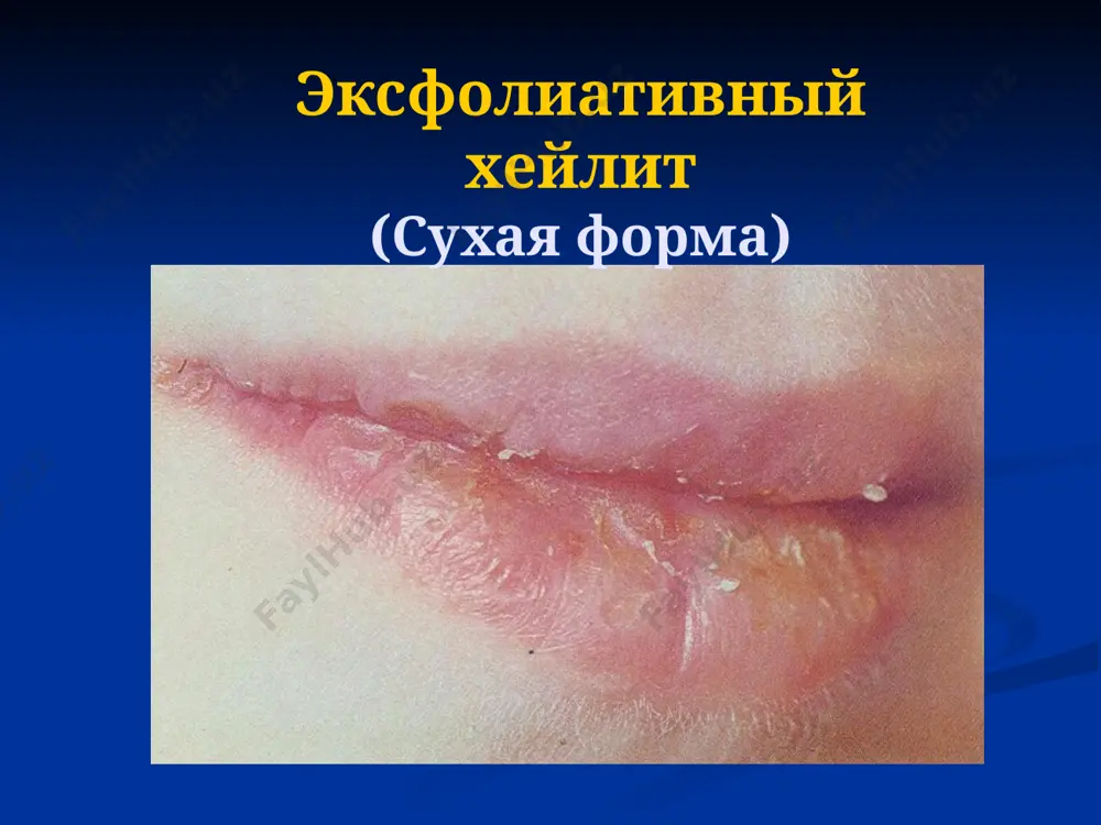 иятия, направленные на: 1) борьбу со старением организма 2) предупреждение и лечение желудочно-кишечной патологии 3) предупреждение и устранение всех видов травм губ и сопр 4) борьбу с курением 5) радикальное лечение хронических воспалительных процессов в области губ и сопр 6) систематическую санацию полости рта 7) профилактические осмотры населения с целью выявления ранних изменений, особенно у лиц, связанных с проф. вредностями. 8) санитарно-просветительную работу 9) диспансерное наблюдение за больными с предраковыми заболеваниями, которое включает три этапа: 1 этап - диспансерный отбор; 2 этап - диспансерный учёт; 3 этап - диспансерное наблюдение и лечение. image1.png image2.png image3.png image4.png image5.png image6.png image7.png image8.png image9.png image10.png image11.png image12.png image13.png image14.png image15.png image16.png image17.png image18.png image19.png image20.png image21.png image22.png image23.png image24.png image25.png image26.png /docprops/thumbnail.jpeg