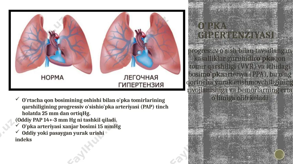 buzilishlar: glikogenni saqlash kasalliklari, qalqonsimon bez kasalliklari •5.4 boshqalar: o'sma lezyonlari tufayli o'pka tomirlarining obstruktsiyasi,fibrozlanishmediastinit, surunkali buyrak etishmovchiligi, dializ tug'ma yurak nuqsonlari (eizenmanger sindromi) sindrom(murakkab)eyzenmenger (icd kodi 10) - konjenital yurak kasalligi bilan bog'liq bo'lgan pulmoner arteriya tizimidagi gipertenziyaning qaytarilmas shakli. bu holat qonning o'ngdan chapga sezilarli darajada oqishi bilan har qanday rivojlangan nuqson bilan rivojlanishi mumkin, deb ishoniladi prognozni belgilovchi omillar: turi: oddiy (asd (4-6%), vsd (10%), pda (100%), o'pka venasi anomaliyasi; kombinatsiyalangan. o'lchamlari: kichik (asd 2 sm dan kam, vsd 1 sm dan kam); katta (asd 2 sm dan ortiq (10%), vsd 1 sm dan ortiq (50%) bilan bog'liq ekstrakardial anomaliyalar. yurak nuqsonlarini tuzatish holati patogenez patogenez asoslari: endotelial disfunktsiya va shikastlanish vazokonstriktor va vazodilatator biologik faol moddalar o'rtasidagi muvozanat endoteliy qayta tuzilishga uchraydiva qon tomir tonusini normal tartibga solish qobiliyatini yo'qotadi. endotelial hujayralar mushak tonusining asosiy regulyatorlari bo'lib, azot oksidi (no), prostatsiklin ishlab chiqaradi, endotelin uchun retseptorlarga …