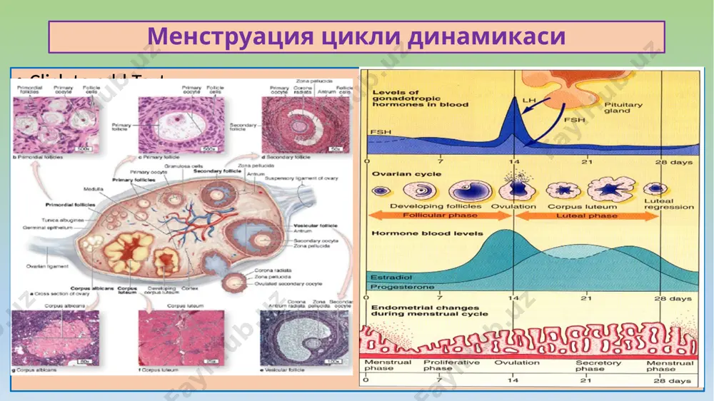 формаси, аденоз ёки мазоплазия дейилади. без бўлаклари ва чиқарув найчалари эпителийси гиперпла-зияланган, зич склероз билан ўралган. ҳомиладорлик ва туғишдан кейинги давр касалликлари ҳомиладорликка боғлиқ касалликлар: 1) токсикоз (преэклампсия), 2) бачадондан ташқари ҳомиладорлик, 3) ўз-ўзидан аборт, 4) бола ташлаш, 5) чала туғилиш. туғиш ва абортдан кейинги касалликлар: 1) плацентар полип, 2) елбўғоз, 3)синцитиал эндометрит, 4) трофобласт касаллик, 5) хорионкарцинома. преэклампсия, бу – ҳомила метаболитлари ва токсинлари таъсирида она организмининг захарланиш касаллигидир. патогенези: буйрак дисфукцияси, гормонал, иммунологик, нейроген бузилишлар, коагулопатия. патологик анатомияси – бош мия, ўпка, юрак, жигар, буйрак майда томирларида тарқоқ тромбозлар, тўқимасига қон қуйилишлар, паренхимасида некрозлар аниқланади. асоратлари: двс синдром, help-синдром, бош мия, ўпка ва жигарга массив қон қуйилишлар. ўлим сабаблари: жигар ва буйрак етишмасликлари, двс-синдром, ҳаётий муҳим аъзоларга қон қуйилишлар. 10 бачадон найи ҳомиладорлиги бачадондан ташқаридаги ҳомиладорлик: бачадон найи, тухумдон ва қорин бўшлиғида бўлиши мумкин. бачадон найи ҳомиладорлиги – суринкали яллиғланиш, туғма аномалия, ўсмаларда, тухум ҳужайра харакатланишдан тўхтаб, шу …