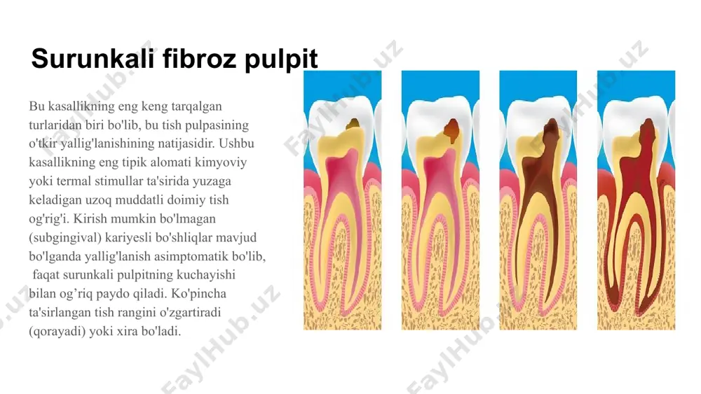 usul asosan bolalar stomatologiyasida qo'llaniladi; to'liq (ekstirpatsiya) - butun "nerv" olib tashlanadi, shu jumladan tish ildizidan. devital usul fibroz pulpit bilan davolashning ushbu usuli kamdan kam qo'llanilmoqda, chunki u tanaga shikast yetkazadi va fiziologik jihatdan kamroq ta'sir qiladi. ushbu usul “nerv" ni maxsus dorilar bilan oldindan o'ldirishni, so'ngra uni yo'q qilishni o'z ichiga oladi. bugungi kunda devital amputatsiya qo'llanilmaydi surunkali fibroz pulpitning diagnostikasi tashxis qo'yish nafaqat bemor bilan suhbatlashish va uning og'iz bo'shlig'ini tekshirish asosida, balki qo'shimcha tadqiqotlar natijalari asosida ham amalga oshiriladi. qo'shimcha diagnostika usullari sifatida tish shifokori quyidagilardan foydalanadi: palpatsiya: zondlash: natijada pulpa kamerasida teshik borligi aniqlanadi; termometriya: shprits bilan sovuq suvni yetkazib berish orqali harorat stimulyatorlariga reaktsiyaning mavjudligi yoki yo'qligi aniqlanadi; rentgen diagnostikasi; perkussiya: reaktsiya yo'q; elektroodontodiagnostika: oqim ta'sirida pulpa qancha vaqt davomida o'z kuchini saqlab qolganligini aniqlashga imkon beradi. e’tiboringiz uchun rahmat image1.png image2.jpeg image3.jpeg image4.jpeg image5.jpeg image6.jpeg image7.jpeg image8.jpeg image9.jpeg image10.jpeg image11.jpeg