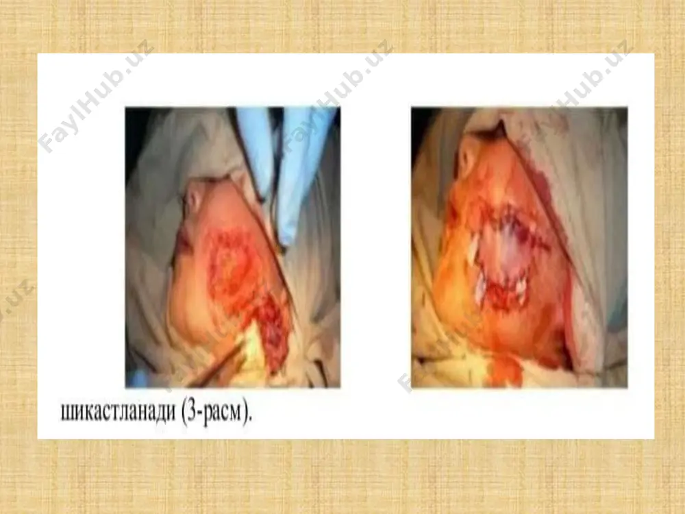 b sinishi. klinik manzarasi: otiz atrofidagi tuximalar (lablar, lunj)da shish, xontalash, tilingan, shilingan yoki ezilib yirtilgan yaralarni kurish mumkin). otiz ichiga karalganda: lablar va lunjda shish, xontalash, tishlar ruparasida yirtilgan yara borligi xamda alveolyar usixda sinish chizigi buylab milkning yirtilgan yarasi va suyakning yalangochlanganligini kurish mumkin. tish katorining yoy shakli buzilgan, tishlam-notugri. paypaslanganda, singan bulak ximirlaydi. barmoxni bulakka xuyib, extiyotkorlik bilan kimirlatib, sinish chizigini anikdash mumkin. sinix bulak va sinish chizigida joylashgan tishlar perkussiyasi ogrixli buladi suyakni urab turgan yumshok tukimalar xolati e'tiborga olinib, yopik (asoratlanmagan) va ochik (asoratlangan) sinishlar ajratiladi. yopik sinish deganda, suyakning ustidagi (koplam) shillik parda va teri yaxlitligi buzilmaganligi nazarda tutiladi. sinish chizigiga tashkaridan infektsiya tusha olmaydi, shuning uchuy jaroxat asoratlanmagan xisoblanadi. ochik sinishda esa singan suyak, ogiz, burun, yutsori jag bushlikdari yoki yumshok tukima va teri jaroxatlari orkali tashki muxit bilan tutashadi. bun day jaroxatlarda sinish soxasiga bushlikdardan va tashkaridan infektsiya yoki boshka yot jismlar …