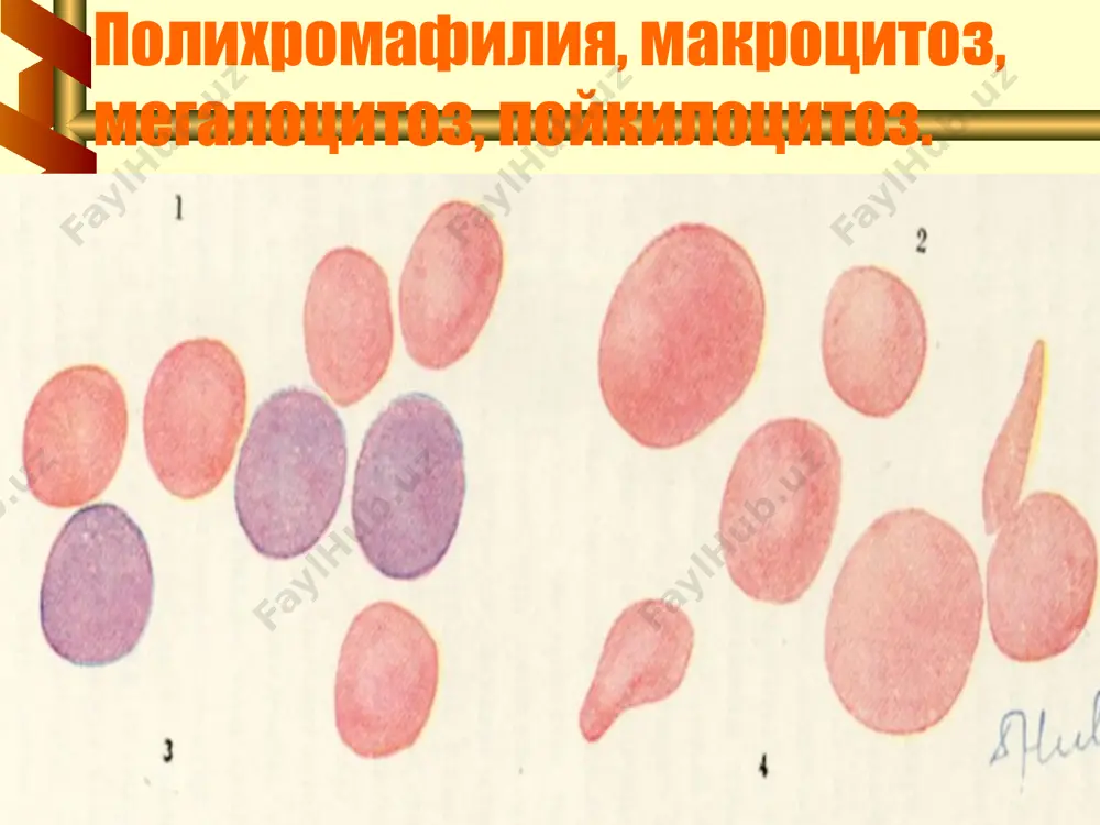 . 42 эритремия диагнози мезонлари диагноз учта катта ёки иккита катта ва иккита кичик мезонлар мавжуд булганда тасдикланади катта мезонлар: эритроцитлар ошиши спленомегалия коннинг кислород билан туйиниши нормал 43 кичик мезонлар: тромбоцитоз 400х10*9/л ва ундан куп лейкоцитоз 12х10*9/л ва ундан куп нейтрофиллар ишкорий фосфатазаси активлиги ошган вит. в12 ёки кон оксиллари в12 боглаш кобилияти ошиши 44 45 46 сурункали лимфолейкоз. сурункали лимфолейкоз (хлл) – лимфатик тукиманинг ёмон сифатли усма касаллиги булиб, бунда суяк кумиги жарохатланиши кузатилади ва усма субстрати етилган лимфоцитлар хисобланади. 47 слл клиникаси. бошлангич даврда умумий холсизлик, куп терлаш, озиш, харорат ошиши безовта килади. кейинчалик сариклик синдроми , геморрагик синдром кузатилиб, гемолитик анемия ва тромбоцитопенияга боглик. объектив: тери ва шиллик каватлар рангпар, лимфа тугунлар катталашиши (буйин, жаг ости, култик ости, чов). лимфа тугунлар юмшок, хамирсимон консистенцияли, симметрик жойлашган. 48 слл диагностикаси. умумий кон тахлили. анемия лейкоцитоз 10-15 дан 600х10*9/л гача, абсолют лимфоцитоз 80-95% гача, пролимфоцитлар, гумпрехт соялари. тромбоцитопения …