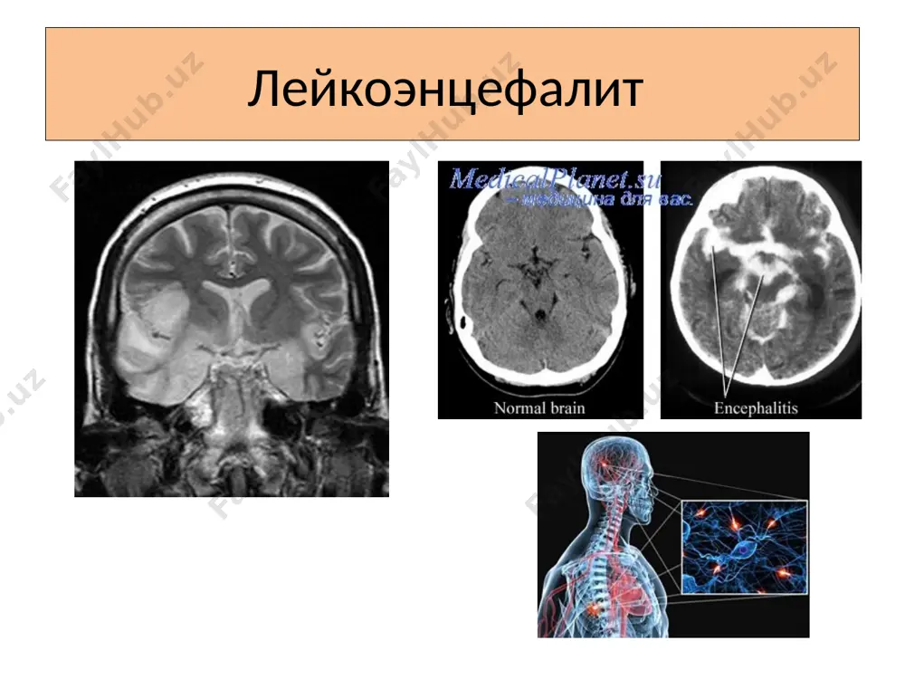 а энцефалитидан дарак беради. беморнинг ташқи кўриниши худди айб иш қилиб қўйиб, бошини эгиб танбеҳ эшитаётган талабани эслатади. © z.ibodullaev. ©www.asab.uz клиникаси-3 ушбу симптомнинг юзага келиши n. accessorius ядроси ва с1-3 сегментларнинг олдинги шохи ядролари дегенерацияси билан боғлиқ. бемор бошини қўли билан иягидан ушлаб кўтариб юради. булбар симптомлар, яъни дисфагия, дисфония ва дизартрия пайдо бўлади. аммо улар яққол ифодаланган бўлмайди. © z.ibodullaev. ©www.asab.uz мускуллар нега озади? 1 ҳафта ўтгач, тана ҳарорати пасая бошлайди. менингеал симптомлар орқага чекинади ва оғриқлар камаяди. касаллик енгил кечган ҳолларда периферик фалажлик белгилари камайиб, ҳаракат функциялари бутунлай тикланади. касаллик оғир кечса бўйин ва елка мускулларида умрбод атрофик фалажликлар сақланиб қолади. бироқ тикланиш даври бир йилгача давом этишини эсда тутиш лозим. © z.ibodullaev. ©www.asab.uz кана энцефалитининг атипик кечиши кана энцефалити 5—10 % ҳолларда атипик тарзда кечади. касалликнинг атипик кечувчи турлари — булар менингит, хореик гиперкинезлар, жексон ва кожевников типидаги эпилепсиялар, деменция, тарқоқ энцефаломиелит, миелит ва полирадикулоневропатиялар. © …