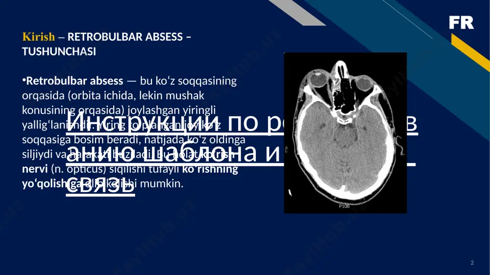 r izoh ko‘zning oldinga siljishi (ekzoftalm) bosim natijasida ko‘z harakatining buzilishi oftalmoplegiya ko‘rishning pasayishi n. opticus siqilishi qizarish, shish yuz, ko‘z atrofi burun bitishi, og‘riq asosiy sabab sinusit isitma, umumiy holsizlik septik holatga yaqinlashadi 👁️ klinik belgilari umumiy simptomlar: qizg'in harorat, titroq, leykotsitoz va esr ortishi va septik kasallikning boshqa belgilari. mahalliy o'zgarishlar ekzoftalmoga, cheklovga kamayadi ko'z olmasining harakatchanligi va orbitaning qon tomir-limfa tizimida turg'unlik bilan bog'liq boshqa kasalliklar. fr 8 🛠️ diagnostika klinik tekshiruv: ekzoftalm, qovoq shishishi, ko‘z harakatlarining buzilishi. burun orqali irinli ajralmalar bo‘lishi. laborator: oak: leykotsitoz, echt oshgan. crp: yuqori. vizualizatsiya: kt (kompyuter tomografiya): orbital absess, sinusit belgilarini ko‘rsatadi. mrt (magnet-rezonans tomografiya): yumshoq to‘qimalarni yaxshi ko‘rsatadi. fr 9 💉 davolash konservativ (boshlang‘ich bosqichda): keng spektli antibiotiklar (seftriakson, metronidazol). og‘riq qoldiruvchilar. yallig‘lanishga qarshi dorilar. jarayon chuqurlashsa – jarrohlik: sinus drenaji (etmoidektomiya, frontotomiya). orbital absessni drenajlash – retrobulbar sohada kesma orqali yiring chiqariladi. jarayon lor va oftalmolog hamkorligida o‘tkaziladi. …