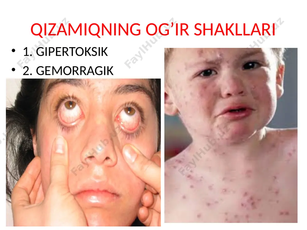 havo-tomchi kasalliklarining og'ir shakllari - Page 5
