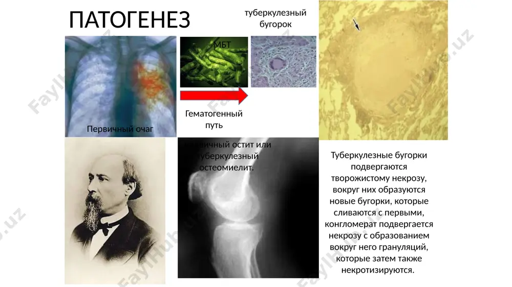 hildren, that at present disease most often are subjected to the people of the old age. moreover, beside elderly people in recently on share bone-joint tuberculosis happens to 72-75% all diseases of the tuberculous nature beside persons this age group suyak-bo'g'im sili asosan ko'krak va bel umurtqalarini zararlaydi. suyak-bo'g'im sili ichida sil spondiliti 40% ni tashkil qiladi. 20 % xollarda chanoq son bo'g'imi sili, 15% xollarda esa tizza bo'g'imi sili uchraydi. yassi suyaklar (qorvurg'alar, to'sh suyagi, kalla suyagi) sili, kaft va barmoq suklari sili, yelka va boldir panja bo'g'imi sili esa nisbatan kam uchraydi чаще всего костно-суставной туберкулёз поражает поясничные и грудные позвонки. туберкулёзный спондилит, составляет 40% случаев всех форм костно-суставного туберкулёза. нередко встречается туберкулёз тазобедренного (20%) и коленного (15%) суставов. гораздо реже выявляют туберкулёз плоских костей (ребер, грудины, костей черепа), запястных костей и фаланг, а также туберкулёз плечевого и голеностопного суставов most often, bone-joint tuberculosis strikes lumbar and breast …