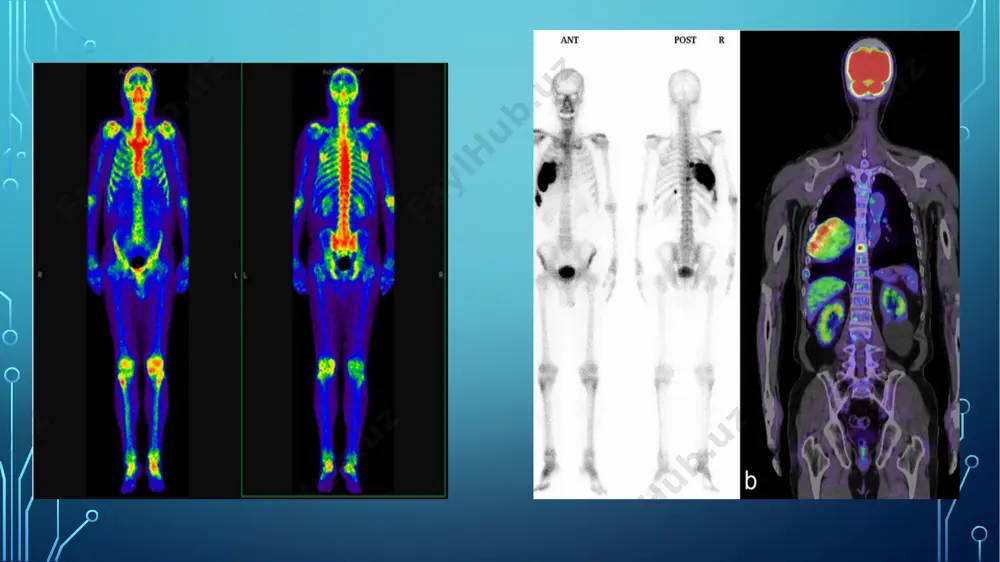 da rivojlanishining buzilish sabablarini aniqlashda; 5akushyerlik va ginekologiyada: esterol, progesteron konsentrasiyasini aniqlash orqali homilaning rivojlanishini nazorat qilish, ayollarda bepushtlikning sababini o‘rganishda; 6.gemopoetik va immunologax sistemani o‘rganishda; 7. allergologiyada: immunoglobulin ye va o‘ziga xos reagyentlarni apiqlashda; 8. farmakoterapiyada: preparatlarning organizmda o‘zgarishini o‘rganish va ta`sirchanligini nazorat qilishda; 9. toksikologiyada: qabul qilingan dori-darmon va zaharli moddalar konsetrasiyasini qonda aniqlash va o‘lchashda. in vivo radionuklid tekshirish usullari bu usullar quyidagilarda qo‘llaniladi: a`zolar, to‘qima va sistemalarda yuborilgan rfp ning garqalishi va bo‘linish xarakterini o‘rganish hamda anatomo-topografik holat to‘grisida ma`lumot olish uchun. usul statik radionuklid tekshirish deb ataladi; bemorda rfp passaji (surilish harakati) dinamikasini aniqlash, tekshirilayotgan a`zo yoki sistemaning faoliyati to‘g‘risida ma`lumot olish uchun. usul dinamik radionuklid tekshirish deb ataladi. statik radionuklid tekshirish usullari ichki a`zolarning anatomo-topografik holatini o‘rganish, a`zolar va to‘qimalarning joylashishi, shakli, o‘lchami, rfp ko‘p yig‘ilgan ("issiq") yoki kam yig‘ilgan ("sovuq") o‘choq yoki zona borligi to‘g‘risida ma`lumot olishda yordam beradi. tekshirish vazifasiga: a`zoning topografiyasi …