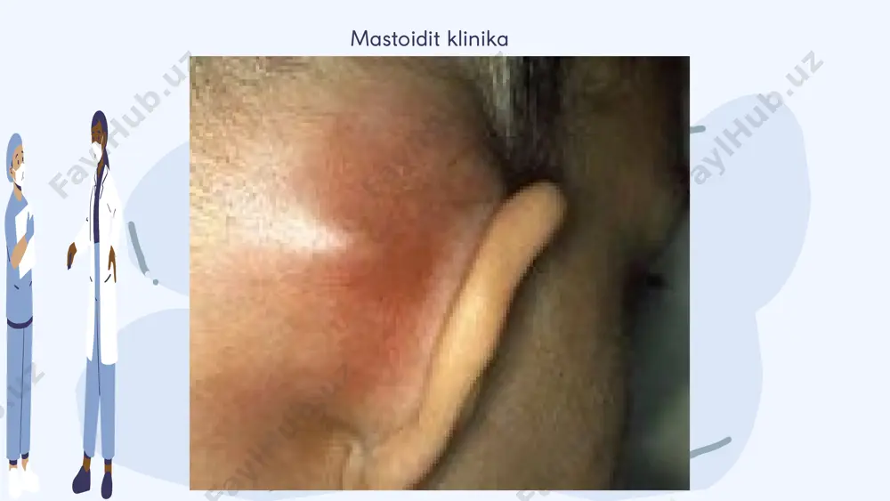antrit va mastoidit differensial diagnostika - Page 4