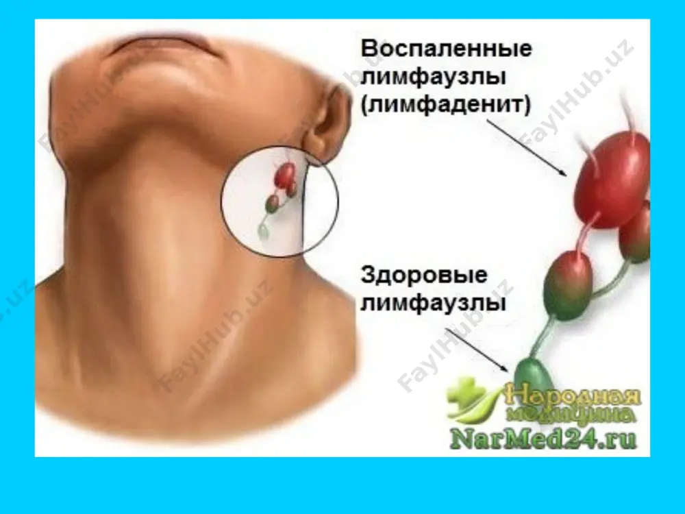 а и чаще поражает представителей белой расы. лимфогранулематоз может возникнуть в любом возрасте. однако существует два пика заболеваемости: в возрасте 20—29 лет и старше 55 лет. и мужчины, и женщины, за исключением детей до 10 лет (чаще болеют мальчики) болеют лимфогранулематозом одинаково часто, но мужчины всё же несколько чаще, с соотношением 1,4:1. частота возникновения заболевания — примерно 1/25000 человек/год, что составляет около 1 % от показателя для всех злокачественных новообразований в мире и примерно 30 % всех злокачественных лимфом. стандартизованные показатели заболеваемости лимфогранулематозом колеблются в пределах 0,6—3,9 у мужчин и 0,3—2,8 у женщин. в нашей стране по данным выборочных исследований показатели заболеваемости лимфогранулематозом, хлл, лимфо- и ретикулосаркомами почти идентичны. среди заболевших лимфогранулематозом мужчины составляют 60—70%, за исключением нодулярного склероза, который диагностируется в основном у женщин. он встречается во всех возрастах, включая новорожденных, в 3 раза чаще в семьях, где уже имелись такие больные. теории возникновения лимфогранулематоза: вирусная - лимфогранулематоз ассоциирован …