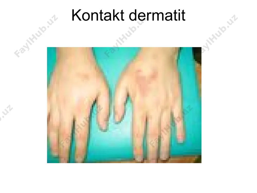 -10ml v/i №10 kalstiy xlor 10% -10ml v/i №10 magniy sulfat 25% -10ml m/o №10 2. enterosorbentlar: aktivlangan ko’mir, enterosorbent polifepan. 3. antigistaminlar - ketotifen - suprastin - analergin - diazolin - dimedrol - loratal - tavegil 4. vitaminlar: askorbin kislota, vitamin v guruxi 5. dezintoksikastion terapiya: gemodez, reopoliglyukin, natriy xlor, dekstran. 6. glyukokortikoidlar deksametazon, gidrokortizon, perednizolon 7. anabolik garmonlar 8. kaliy preparatlari mahalliy davolash - namli bog'lam qo’yish: 2% borat kislota, rivanol, rezorstin - anilin bo’yoqlari: fukorstin, metilin ko’ki, brilliant yashili. - epitelizastiya uchun gelva malhamlar: solkoseril, aktovegen, kuriozin. steroidli malhamlar va kremlar - antibiotikli malhamlar - ogiz shilliq pardalari uchun: furastilin, romashka 1%li borat kislota, kasalxonaga yotqizishga ko’rsatmalar kasallikning o’tkir kechishi umumiy axvolining ogirligi ish faoliyatining pasayishi ambulator davolashning samarasizligi qiyosiy tashxis 1. pushtirang temratki 2. zaxm 3. psoriaz 4. qizil yassi temratki 5. akantolitik pemfigus 6. lever pemfigoidi 7. dyuring dermatiti