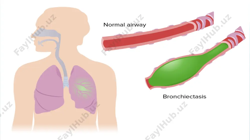 doz bronxoektaz klinikasi ertalabki bezovta qiladigan yo’tal yo’tal bilan yiringli balg’am ajralishi balg’am miqdori 150-200 ml (500 ml<) tana harorati 38-39 c atrofida 30-50% bemorlarda qon tuflash, ozish ko’krak qafasi deformatsiyasi baraban tayoqchasi va soat oynasi perkussiyada emfizematoz tovush auskultatsiyada jarangsiz nam xirillash laborator-diagnostika umumiy qon taxlilida leykotsitoz, echt oshishi qon zardobida alfa-1 antitrypsin kamayishi(emfizemali bemorlarda) balg’am uch qavatli bo’lishi bakteriologik tekshiruvda turli microflora anialanadi rentgenda peribronxial fibroz, atelektaz, kistoz hosilalar, deformatsiya bronxografiya qo’zg’almagan davrda o’tkaziladi kt ishonchli noinvaziv usul hisoblanadi tashqi nafas faoliyati aniqlanishi bronxoobstruksiya sindromini erta aniqlashga yordam beradi bakteriologik tekshiruvda:haemophilius influenza, streptoccus pneumonia, stapylococcus aureus, anaerob bakteriyalar, sil mikobakteriyalari va zamburug’lar aniqlanadi davolash parxez rejimiga rioya qilinadi,yuqori kaloriyali ovqatlar iste’moli(3000 kkal) oqsil-110-120 g, yog’lar kamaytiriladi.a,b,c guruh vitaminlar, ko’p suyuqlik ichish. qo’zigan davrda 1-2 hafta amoksatsillin kunda 1500 mg va klavulant kislotasi beriladi.har qo’zish davrida ab lar almashtiriladi. bronxlar sanatsiyasini tiklash maqsadidavibromassaj va muntazam gimnastika, mukoregulator va mukolitiklar …