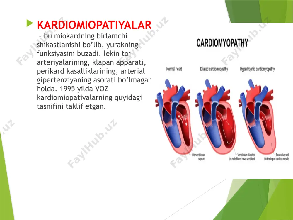 fositlar miqdori oshganligi kuzatiladi. patogenezi. ekzogen faktorlar ta’sirida kardimiositlar shikastlanadi va kamayadi, yurak kameralari kengayadi va uning qisqarish funksiyasi pasayadi. yurak yetishmovchiligi rivojlanadi. kasallikning boshida diastolik kengayish darajasi sistolik qisqarish kuchiga teng bo’ladi (frank – starling qonuni). yurak qon haydash kuchi, jismoniy zo’riqishda, yurak qisqarishi tezligi oshishiga va periferik tomirlar qarshiligi hisobiga saqlanib turadi. lekin vaqt o’tishi bilan kompensator mexanizmlar buziladi: yurak elastik kengayishi buziladi, sistolik disfunksiya rivojlanadi. klinik manzarasi yurak yetishmovchiligi, aritmiyalar va tromboemboliya rivojlanishi bilan xarakterlanadi. shikoyatlar uzoq vaqt bo’lmasligi mumkin. yurak yetishmovchiligi simptomlari – nafas qisishi, holsizlanish, taxikardiya, periferik shishlar. keyinchalik kichik qon aylanish doirasida qon dimlanishi simptomlari – nafas qisishi, o’pkada nam xirillashlar, ortopnoe, yurak astmasi. dk tez paydo bo’luvchi belgilaridan biri bu doimiy xilpillovchi aritmiyaning rivojlanishi. yurak perkussiyasida yurak chegaralari kengayganligi, auskultasiyada – tk va mk ustida sistolik shovqin eshitiladi. tromboemboliya (te) ko’pincha o’pka ariteriyasi tromboemboliyasi (tela) bilan yoki miya tomirlari te bilan kuzatiladi. ekg. …