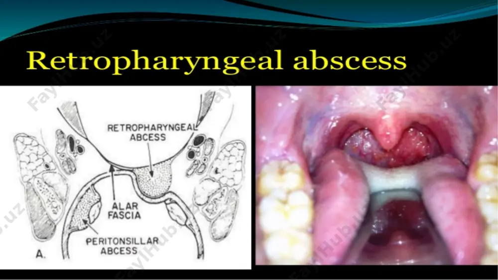 retropharyngeal abscess - Page 5