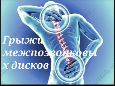 грыжи межпозвонковых дисков — PPTX