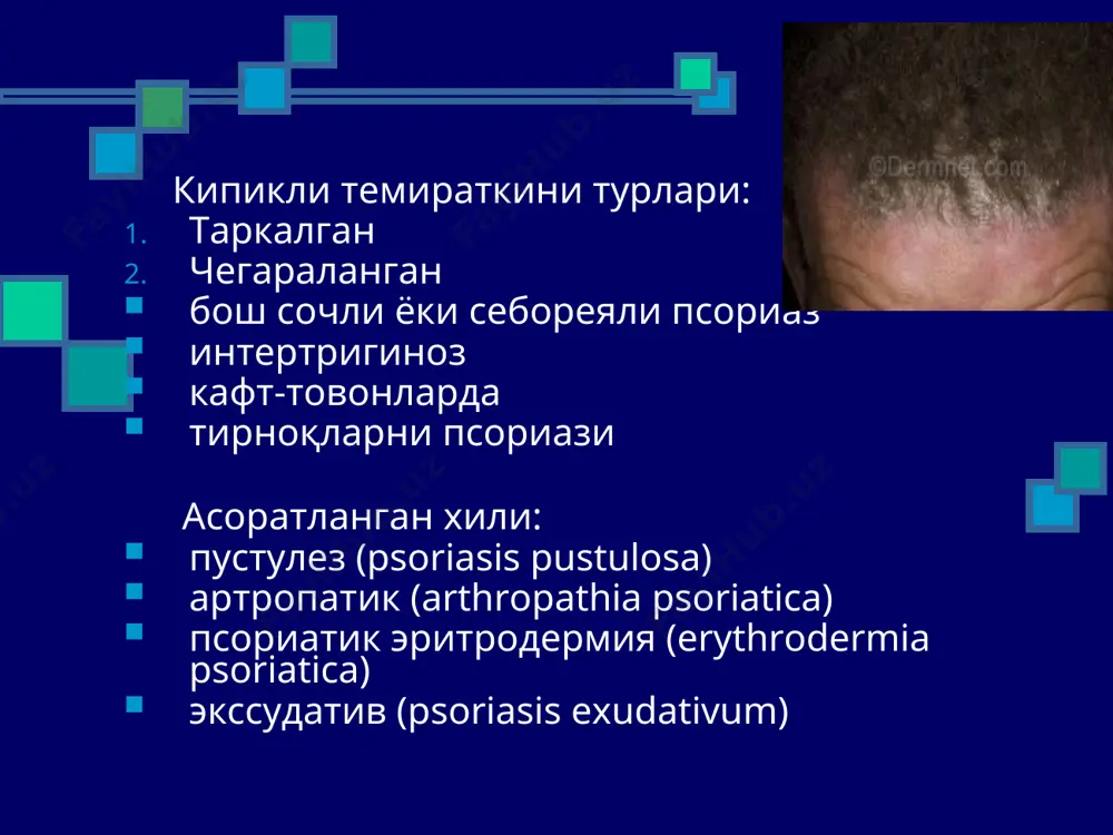 ланиш кўринади. 3-4 кундан кейин, майда пилакчалар (қизча пилакчалар) аста-секин пайдо бўла бошлайди. тошмалар кўпроқ танада, камроқ оёқ-қўлларда, майда 1–3 мм дан то 1–2 см гача катталикда бўлиб, лангер чизиқлар йўналиши бўйича жойлашадилар. ..\..\1 183.jpg