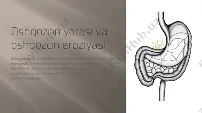 oshqozon yarasi va oshqozon eroziyasi — PPTX