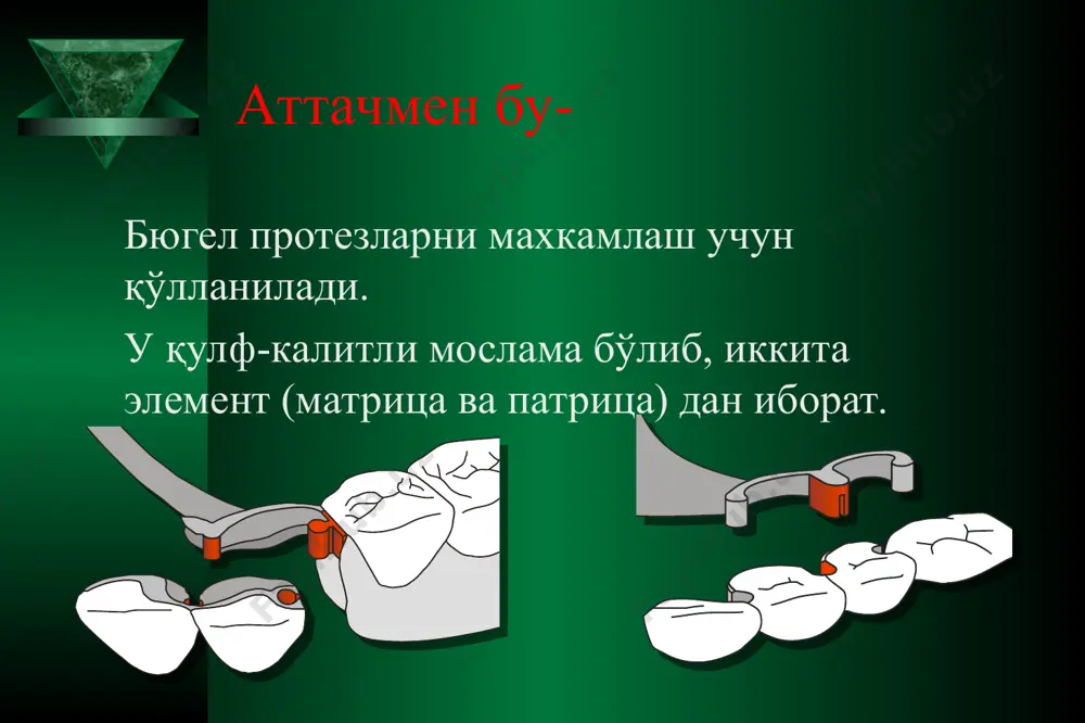аттачменларни қўллаган ҳолда йўйли (бюгель) протезларини тайёрлаш - Page 3