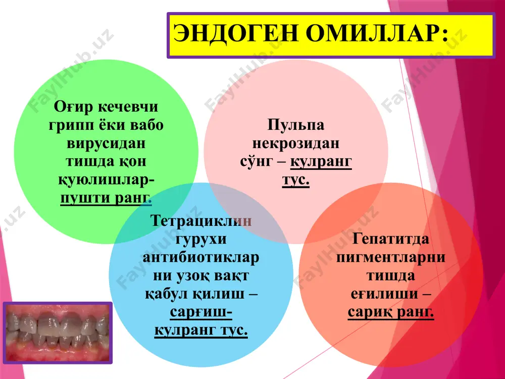 егарасида жойлашган юза кемтиксимон понасимон нуқсонлар. чуқурлиги 0,2 мм, узунлиги 3 – 3,5 мм гача. тиш бўйин қисмида – гиперэстезия. 40-45° бурчак остидаги иккита юза натижасида вужудга келган ўрта понасимон нуқсонлар. ўртача чуқурлиги 0,2-0,3 мм, узунлиги 3,5-4 мм. чуқур понасимон нуқсон, узунлиги 5 мм ва ундан кўп. дентинни чуқур қаватларини, хатто тиш бўшлиғи сохасигача жараён давом этиб, тиш тожини синиши билан якунланади. нуқсон туби ва деворлари силлиқ, ялтироқ, қирралари текис. понасимон нуқсон понасимон нуқсоннинг қиёсий ташхиси: понасимон нуқсон юза кариес ўрта кариес чуқур кариес тиш эрозияси флюорознинг эрозив шакли тиш некроза понасимон нуксонни даволаш: бошлангич холларда (10% кальций глюконат, 2% натрий фторид эритмаси, аппликацияси қилинади). ўрта ва чуқур нуқсонларда – композит пломбалар билан реставрация қилинади. 42 эмаль эрозияси тиш тукималарининг прогрессив ликобчасимон шаклда емирилиши (эмал ва дентин). этиологияси тўлиқ аниқланмаган. эмаль эрозияси патогенези ю.м.максимовский (1981) эмал эрозияси патогенезида эндокрин бузилишлар, айникса қалқонсимон без гиперфункцияси мухим рол ўйнашини айтиб ўтган ю.а.фёдоров …