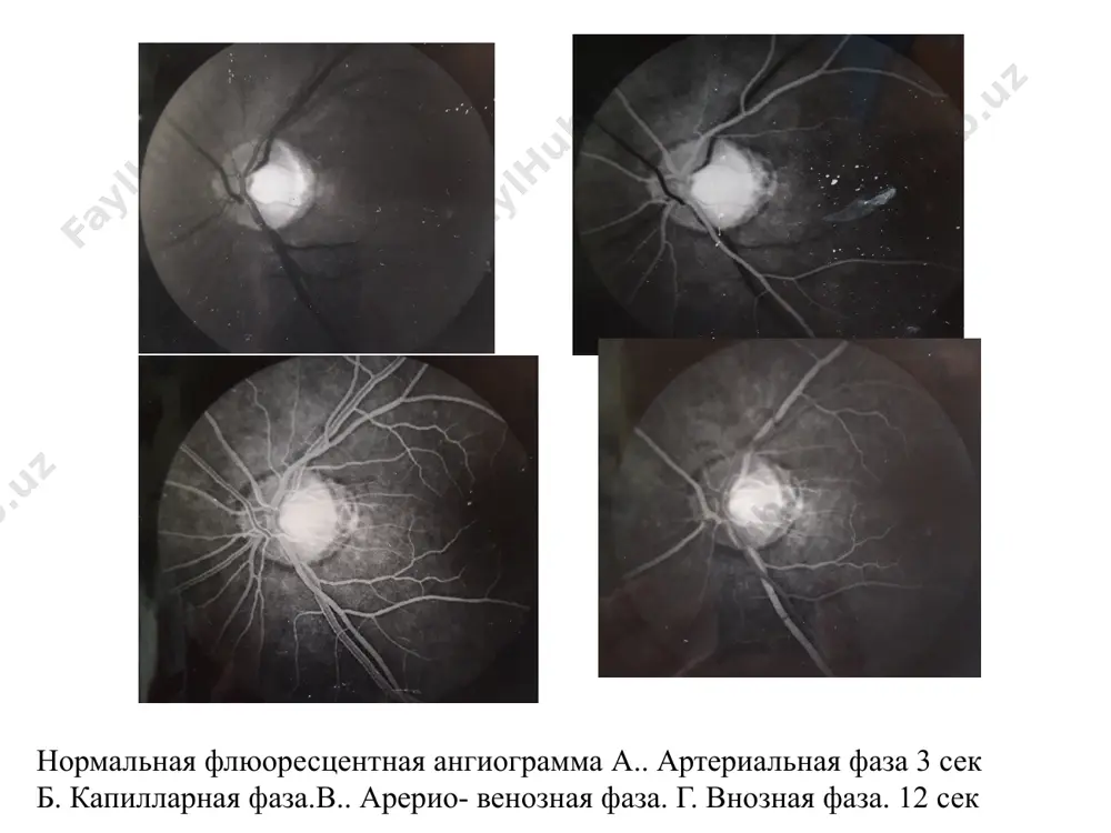 классификация заболеваний зрительного нерва - Page 4