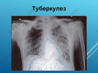 туберкулез — PPT