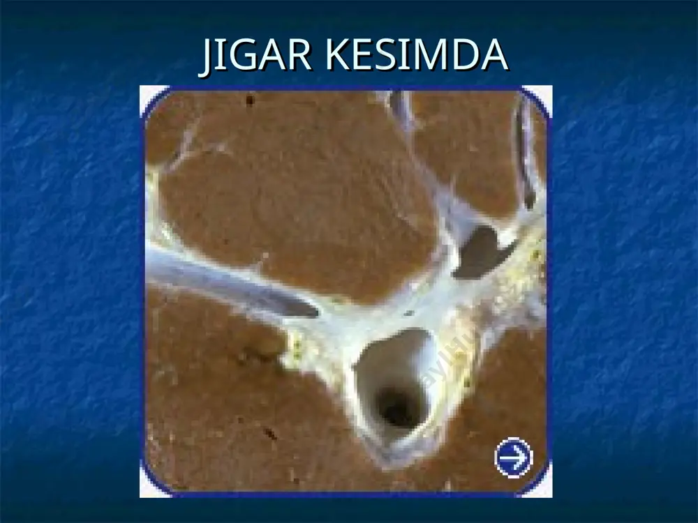 leks etiologiyasi viruslar infeksion kasalliklar dori vositalari jigar kasalliklari alkogol isteъmol qilish sanoat toksinlari, mikotoksinlar, aflotoksinlar tasiri yurak etishmovchiligi endogen toksik gepatozlar patogenez jigar etishmovchiligi gepatositlarning distrofiyasi va tarqalgan nekrobiozi, hamda fibroz va portokaval anastomozlar rivojlanishi bilan tushuntiriladi. bu anastomozlar orqali qonning salmoqli qismi jigarni chetlab o'tgan holda darvoza venalaridan kavak venalarga, keyin arterial tizimga tushadi. bu holat jigarning ichakdan so'rilgan zararli moddalarni dezintoksikasiyalashdagi ishtirokini yanada kamaytiradi. klinik ko'rinishi distrofiya va atrofiya sindromi, nevrit rivojlanishi, anemiya; isitma sindromi – tana haroratinining 380 c, hatto 400c gacha ko'tarilishi, leykositar formulaning chapga siljishi, septik holat, bakteriemiya, jumladan haqiqiy ichak bakteriemiyasi sariqlik sindromi – sariqlik avj olishi bilan kechuvchi massiv nekroz klinik ko'rinishi (davomi) endokrin buzilishlar sindromi – urg'donlar atrofiyasi, bepushtlik, ginekomastiya, soch to'kilishi, sut bezlari va bachadon atrofiyasi, teleangiektaziyalar paydo bo'lishi va tezlik bilan kattalashishi, palьmar eritema, «oq tirnoqlar fenomeni» gemodinamika buzilishi sindromi– diffuz vazodilatasiya, shish-assitik sindrom mahsus jigar hidi aniqlanishi gemorragik …