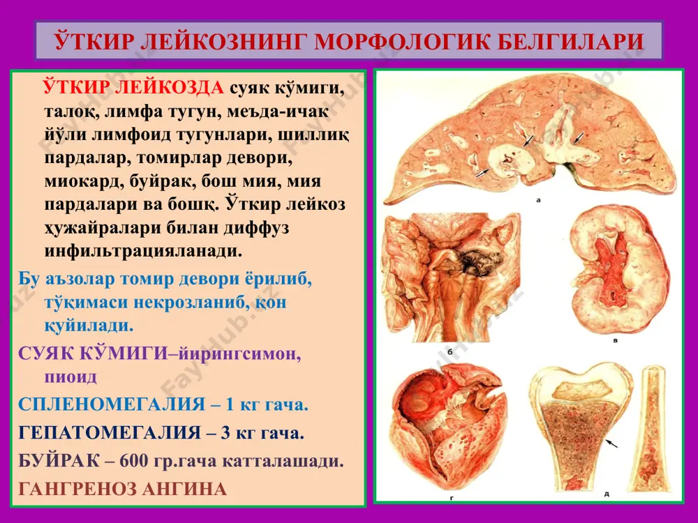 изми- кальций тупланиб сув ва калийнинг камайиши натижасида эритроцитлар мембранаси ригидланади. эритроцитлар талокда секвестрланиб 20кунда нобуд булади ригидланган уроксимон эритроцитлар капиллярларга тикилади эритроцитлар заряди узгариб эндотелийга ёпишади коннинг ивиши тезлашади. гемоглобинопатия уроксимон хужайрали анемияда патанатомия: макро: юрак, жигар, буйрак ёгли дистрофия окибатида оч сарик рангли. талок- спленомегалия (500г) инфаркт учоклари. расм микро: юрак, буйрак эгри-бугри каналчаларида, жигар паренхиматоз ёгли дистрофия. конда уроксимон эритроцитлар ва ретикулоцитоз. суяк кумиги гиперплазияси, экстрамедуляр гематопоэз. умумий гемосидероз, гемохроматоз. расм 3. талассемия бу- гемоглобиннинг a-глобин ва в-глобин занжирлари синтези бузилишидан ривожланадиган ирсий анемиядир. сабаби ва механизми: гемоглобин генлари мутацияси, делецияси ва транскрипцияси, бекарон рнк синтезланиши. патнатомияси: макро: спленомегалия, гепатомегалия, кумик гиперплазияси, суякнинг юпкаланиши, гемосидероз, сариклик. микро: конда- аницитоз, пойкилоцитоз, ретикулоцитоз. эктрамедуляр гематопоэз. расм iii. дисэритропоэтик эритропоэз бузилиши окибатида бошланадиган анемиялар суяк кумигининг гемопоэз учун зарур моддалар билан тегишлияа таъминланмагинлигидан келиб чикувчи анемиядир. турлари: 1.fe танкислигига боглик анемия 2.мегалобластик анемия 3. гипопластик ва апластик анемия 4.миелофтиз анемия …