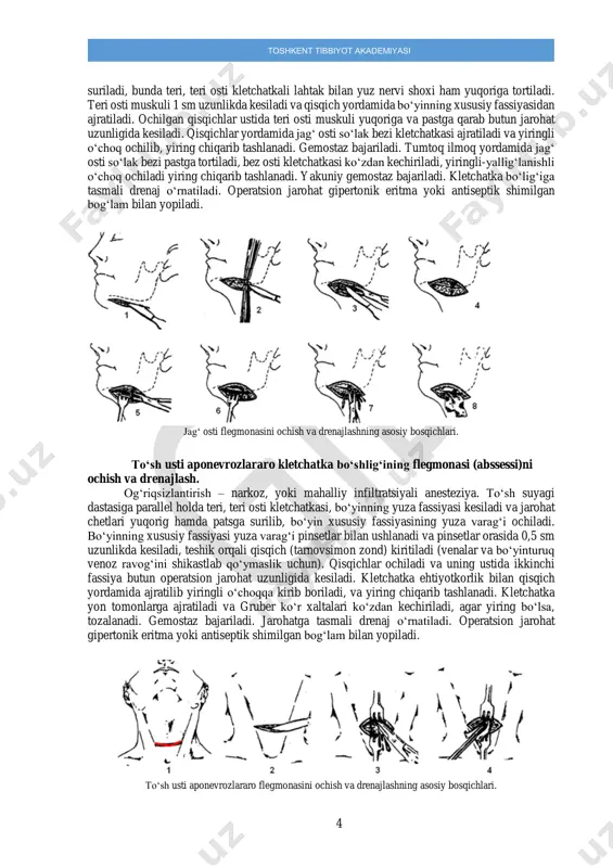 ostaz bajariladi. tumtoq ilmoq yordamida jag‘ osti so‘lak bezi pastga tortiladi, bez osti kletchatkasi ko‘zdan kechiriladi, yiringli-yallig‘lanishli o‘choq ochiladi yiring chiqarib tashlanadi. yakuniy gemostaz bajariladi. kletchatka bo‘lig‘iga tasmali drenaj o‘rnatiladi. operatsion jarohat gipertonik eritma yoki antiseptik shimilgan bog‘lam bilan yopiladi. jag‘ osti flegmonasini ochish va drenajlashning asosiy bosqichlari. to‘sh usti aponevrozlararo kletchatka bo‘shlig‘ining flegmonasi (abssessi)ni ochish va drenajlash. og‘riqsizlantirish – narkoz, yoki mahalliy infiltratsiyali anesteziya. to‘sh suyagi dastasiga parallel holda teri, teri osti kletchatkasi, bo‘yinning yuza fassiyasi kesiladi va jarohat chetlari yuqorig hamda patsga surilib, bo‘yin xususiy fassiyasining yuza varag‘i ochiladi. bo‘yinning xususiy fassiyasi yuza varag‘i pinsetlar bilan ushlanadi va pinsetlar orasida 0,5 sm uzunlikda kesiladi, teshik orqali qisqich (tarnovsimon zond) kiritiladi (venalar va bo‘yinturuq venoz ravog‘ini shikastlab qo‘ymaslik uchun). qisqichlar ochiladi va uning ustida ikkinchi fassiya butun operatsion jarohat uzunligida kesiladi. kletchatka ehtiyotkorlik bilan qisqich yordamida ajratilib yiringli o‘choqqa kirib boriladi, va yiring chiqarib tashlanadi. kletchatka yon tomonlarga ajratiladi …