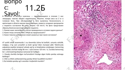 bemorning sababiy uzviyatli shakli (arterit) — PPTX