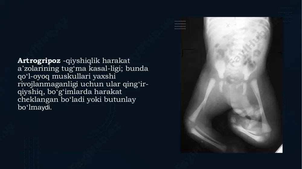 ri tez-tez ta'sirlanadi. • distal. kasal bolalar soni 11% ga etadi. uning 9 ga yaqin kichik turi bor, ular orasida raqamli dismorfizm, tug'ma araxnodaktiliya va boshqalar. artrogripoz belgilari • xarakterli alomatlar tug'ma kontrakturalar va mushak atrofiyasi yoki to'yib ovqatlanmaslikdan iborat bo'lib, bemorlarga juda ko'p noqulaylik tug'diradi. artrogripozdagi lezyonlar nosimmetrikdir va rivojlanishga moyil emas, faqat dastlabki muvaffaqiyatli davolanishdan keyin deformatsiyalarning qaytalanishi mumkin. ko'p hollarda kasallik tananing yuqori qismlarini ushlaydi. oddiy rasm-qo'llar ichkariga keltiriladi va aylantiriladi, bilaklar pronatsiya qilinadi, tirsaklar tekislanadi, qo'llar kaftlar tomon egiladi. asoratlari • artrogripoz hayot uchun bevosita xavf tug'dirmaydi. asoratlar etarli yoki o'z vaqtida davolanmagan holda tez-tez uchraydi. ammo muvaffaqiyatli terapiya bilan ham ijobiy dinamikaga erishmaslik mumkin. kontrakturalarni saqlash bolaga eng oddiy harakatlarni bajarishga xalaqit beradi. jiddiy asoratlar shikastlangan bo'g'imlarning to'liq immobilizatsiyasi va oyoq-qo'llarning doimiy deformatsiyasi hisoblanadi kasallikning ko'rinishi diagnostikasi • artrogripoz odatda muntazam ultratovush tekshiruvi bilan aniqlanadi. ekografiyaga ko'ra, homila harakatsizligi, oyoq- qo'llarning yumshoq to'qimalarining hajmi pasayishi …