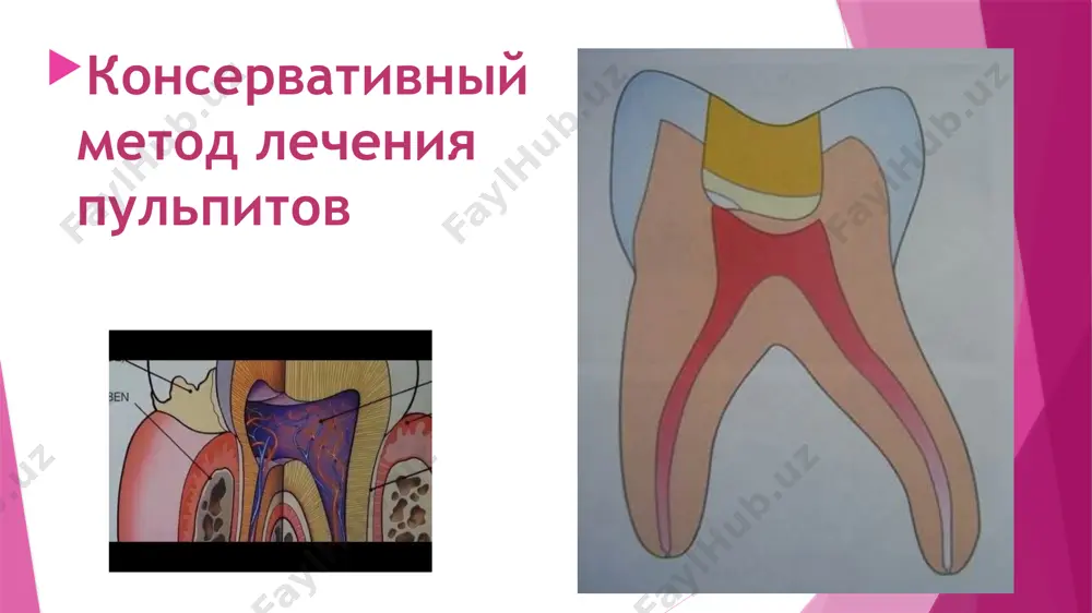 и кариозная полость отсутствует (травматические пульпиты, ретроградный пульпит и т.д.). при проведении трепанации коронки зуба требуется хорошее знание анатомии полости зуба. после проведения пяти этапов механической обработки кариозной полости проводят ее медикаментозную обработку. дальнейшая обработка должна проводиться в условиях максимальной сухости обрабатываемого зуба для исключения проникновения микроорганизмов полости рта в полость зуба. абсолютная сухость операционного поля достигается применением коффердама. следующий этап - раскрытие полости зуба проводится стерильным цилиндрическим бором, особое внимание следует обратить на раскрытие всех рогов пульпы данного зуба и создание хорошего обзора дна полости зуба. затем экскаватором или шаровидным бором проводится ампутация коронковой пульпы. медикаментозная обработка растворами слабых антисептиков. с помощью шаровидного бора производят расширение устьев корневых каналов, можно использовать специальный инструмент - бор gates glidden. для профилактики кровотечения перед экстирпацией пульпы возможно применение диатермокоагуляции (дк) у молодых пациентов с анатомически широкими корневыми каналами. при диатермокоагуляции (дк) пульпы зуба достигается температура нагрева тканей 60-80 град. с, что приводит …