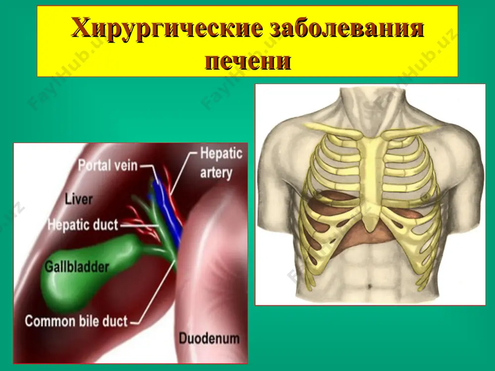 дения печени при прямом воздействии (г.ф. николаев, 2005)‏ 47% 41,2% 11,8% степень тяжести травмы печени (по классификации американской ассоциации хирургов, 2004 г.)‏ 1ст. подкапсульная гематома менее 10% поверхности, не нарастает, разрыв паренхимы в глубь не более 1 см без кровотечения. 2 ст. подкапсульная гематома от 10 до 50% поверхности, не нарастает. разрыв протяженностью менее 10 см и в глубь на 1-3 см. 3 ст. подкапсульная гематома более 50% или нарастающая, разрыв гематомы с кровотечением, центральная гематома на глубине более 2 см. разрыв паренхимы в глубь более 3 см. 4 ст. разрыв центральной гематомы с кровотечением. разрушение 25-50% паренхимы доли печени. 5 ст. разрушение более 50% паренхимы доли печени. повреждение нижней полой вены, крупных печеночных вен. 6 ст. отрыв печени. диагностика повреждений печени осмотр больного: жалобы, анамнез, данные объективного осмотра и локального статуса, физикальные исследования и т.д. лабораторные исследования (puls, ад, hb, ht, l ...). инструментальные исследования (re , узи, кт …