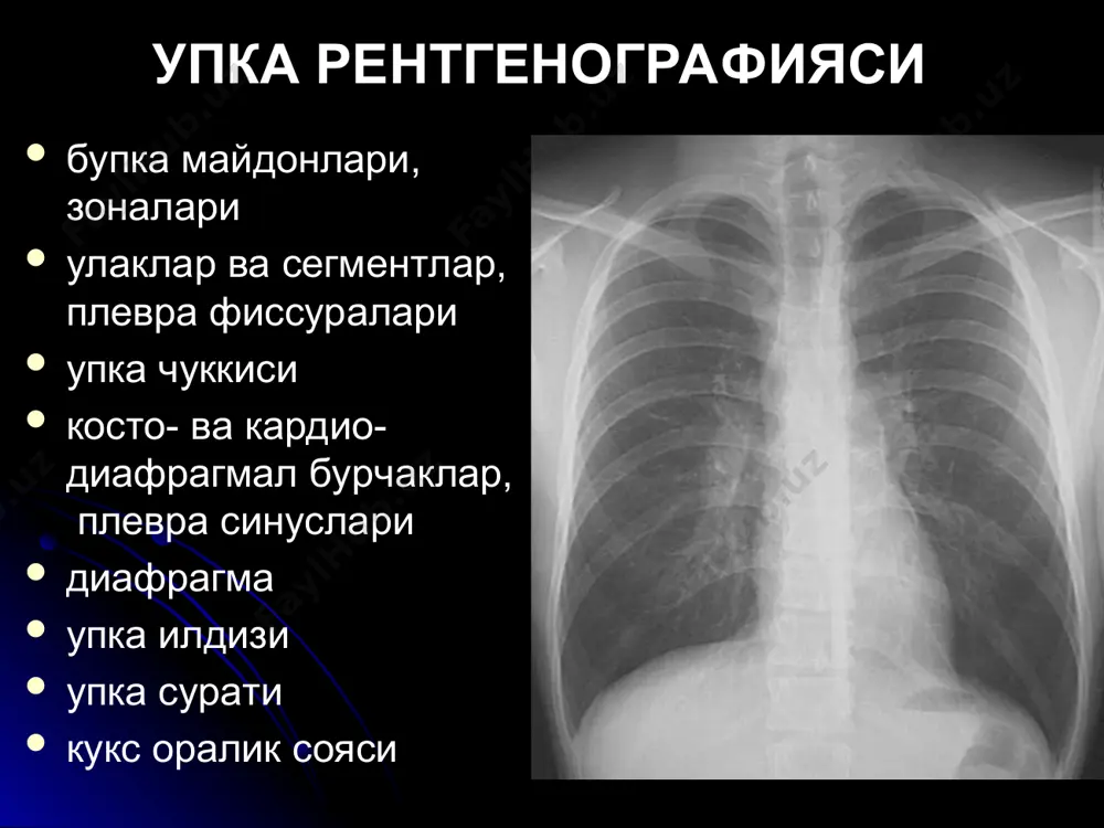 ) - чизикли (фиброзли узгаришлар). сояларни катталиги йирик (зотилжам, усма, метастазлар ўрта (болаларда учокли зотилжам) майда (майда учокли зотилжам) миллиар ( милиар сил, карциноматоз, гемосидероз, пневмокониоз, альвеолит) соя интенсивлиги хира урта интенсив юкори интенсив корайиш оркасида упка сурати куринади (майда соялар, инфильтрация бошлангич даври) корайиш оркасида упка сурати куринмайди (урта учокли патологияларда) корайиш ковургалар зичлигидан хам баланд (катта хажмдаги патологик узгаришлар, охакланган учоклар (петрификат), металл жисм сояси) сояларни структураси - гомоген хавосиз структура (ателектаз, плеврит, эмпиема, крупоз, булакли, сегментар зотилжам) - ногомоген (усманинг емирилиши, упка деструкцияси, кисталар перифокал узгариш билан, диафрагмал чурра) тугри, аник (киста, каверна) нотугри, ноаник (хафвли усма, яллигланиш жараёни, туберкулома) соя контурлари тотал ва субтотал корайиш касалликлар - плеврит, ателектаз, цирроз, пневмония, инфильтратив сил, диафрагмал чурра дифференциал ташхисда мухим 1. кукс оралиги силжиши 2. соя структураси плеврит ва диафрагмал чурра кукс оралигини сог томонга силжитади, ателектаз ва цирроз корайиш томонга, инфильтратив сил ва пневмония силжитмайди гомоген - …
