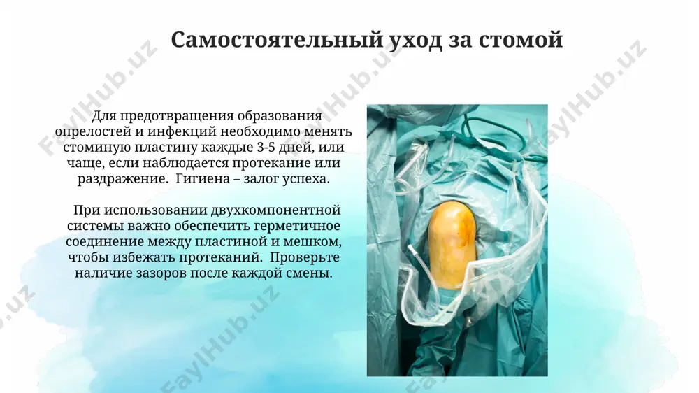 ya, vklyuchaya 10 chasov prakticheskix zanyatiy po obrabotke stomi i viboru podxodyashix prisposobleniy. pitanie pri stome ogranichte potreblenie produktov, vizivayushix gazoobrazovanie (bobovie, kapusta, gazirovannie napitki) na 30-40%, osobenno v nachale adaptatsionnogo perioda, chtobi minimizirovat diskomfort. vklyuchite v ratsion 20-25 g kletchatki ejednevno, postepenno uvelichivaya kolichestvo, chtobi izbejat diarei ili zaporov, ispolzuya produkti, bogatie rastvorimoy kletchatkoy, takie kak ovsyanka i yabloki. dolgosrochniy uxod za stomoy dolgosrochniy uxod za stomoy vklyuchaet regulyarnuyu smenu meshochkov, jelatelno kajdie 3-5 chasov, v zavisimosti ot xaraktera videleniy i individualnix osobennostey patsienta, chtobi predotvratit razdrajenie koji. pravilnoe pitanie igraet klyuchevuyu rol: okolo 70% patsientov s kolostomoy otmechayut uluchshenie sostoyaniya pri upotreblenii pishi s visokim soderjaniem kletchatki i isklyuchenii produktov, vizivayushix vzdutie. smena kalopriemnika dlya predotvrasheniya protekaniya, ispolzuyte spetsialnie kremi ili pasti, sozdayushie germetichnoe soedinenie mejdu kalopriemnikom i kojey vokrug stomi. zamena doljna provoditsya ne reje chem kajdie 3-5 dney. pri smene kalopriemnika neobxodimo sledit za sostoyaniem koji …