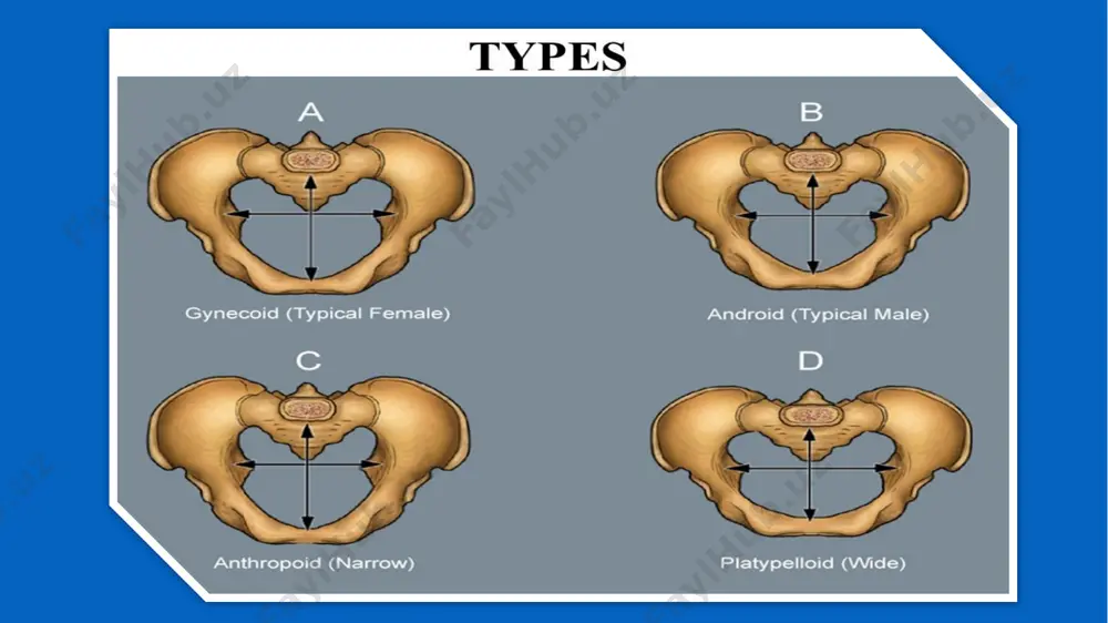 oqqa aytiladi. oddiy yassi chanoq (pelvis plana deventery) chanoqning barcha to‘g‘ri o‘lchamlari toraygan bo‘ladi, qiyshiq va ko‘ndalang o‘lchamlari normada bo‘lishi mumkin. oddiy yassi chanoqning xarakterli belgisi – butun dumg‘aza simfizga yaqinlashgan, shu sababli chanoq kirish, kengaygan,toraygan va chiqish tekisliklarining to‘g‘ri o‘lchamlari qisqargan,ammo chanoq va skelet suyaklari deformatsiyalanmagan. raxitik yassi chanoq (pelvis plana rachitica) faqat chanoq kirish qismining to‘g‘ri o‘lchami (chin konyugata) toraygan bo‘ladi. bunday chanoqli ayolning bo‘yi pastroq, boshi go‘yoki to‘rtburchak shaklda, o‘mrov suyagi “s” shaklida, oyoqlari qiyshiq (“o” shaklida) bo‘ladi. bo‘yin umurtqasi oldinga, ko‘krakniki orqaga, belniki oldinga, dumg‘aza umurtqasi orqaga ko‘p egilgan bo‘ladi. tor chanoqni aniqlash anamnez bilan tanishiladi ayol tanasi ko‘zdan kechiriladi chanog‘i o‘lchanadi qin orqali tekshirish o‘tkaziladi anamnez ma’lumotlaridan raxit, suyak va bo‘g‘imlar sili, infantilizm, chanoq hamda oyoq suyaklarining singanligi va shukabilar haqidagi ma’lumotlar alohida ahamiyatli. ayol tanasi ko‘zdan kechirilganda, chanoqning torligini ko‘rsatuvchi muhim ma’lumotlar olinadi. ayolning past bo‘yligi, raxitik yassi chanoq, umumiy toraygan yassi chanoq,fantilizm belgilari, …