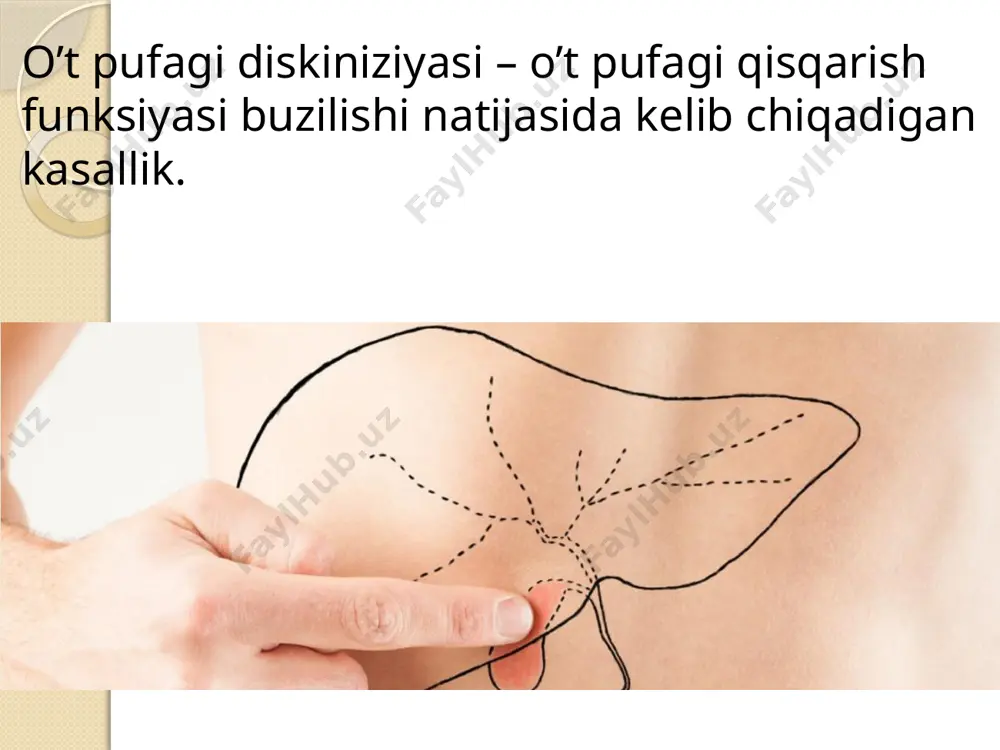 kininning haddan tashqari ko'payishitufayli, o't pufagining gipokinetik disfunktsiyasi - simpatik asab tizimining ohangining ustunligi va xoletsistokinin yetishmasligi yoki ortiqcha bo'lishi bilan yuzaga keladi. vazo ichak peptidi. giperkinetik disfunktsiya ko'pincha qisqarish funktsiyasining buzilishi natijasida yuzaga keladi. klassifikatsiyasi 1.giperkinetik (gipermator) o’t pufagi qisqarish funksiyasi kuchli yoshlarda ko’p uchraydi 2.gipokinetik (gipomator) o’t pufagi qisqarish aktivligi pasayishi 40 yoshdan oshganlarda ko’p uchraydi, tasniflash o't yo'llarining birlamchi diskineziyalarini kasalliklarning mustaqil guruhi sifatida, o't pufagi, o'n ikki barmoqli ichak va oshqozon osti bezining turli kasalliklarida ikkilamchi diskineziyalarni ajratish. diskineziya giperkenetik (gipertonik) va gipokinetik (gipotonik) bo'lishi mumkin. gipertenziv-giperkinetik diskineziyalar uchta variantga ega: o't pufagining gipertenziv diskinezi; kistali kanal va oddi sfinkterining gipertonikligi; bu variantlarning kombinatsiyasi. gipotonik-gipokinetik diskineziya o'zini namoyon qilishi mumkin: o't pufagining gipotenziyasi; oddi sfinkterining etishmovchiligi; bu variantlarning kombinatsiyasi. o't yo'llarining aralash diskineziyasi mumkin, bunda ba'zi tuzilmalarning gipertonikligi o't yo'lining boshqa qismlarining gipotenziyasi bilan birlashadi (gipertenziv-gipokinetik diskineziya). alomatlar diskineziyaning giperkinetik shakllari o'ng tomonda tez -tez uchraydigan …