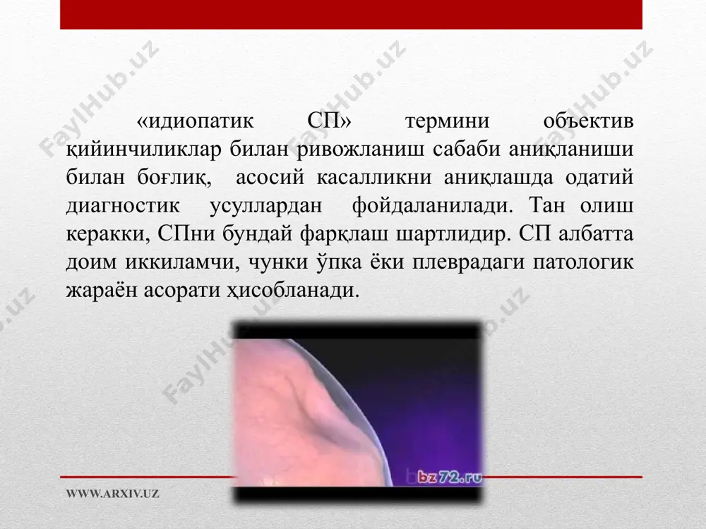 аволаш. госпитализациягача бўлган босқич. беморга биринчи ёрдам кўрсатишда дастлаб орқани кўтариб турадиган ҳолда ўтқизиш керак, беморнинг бошини кўтариш, ойнани очиш, кийимларини ва белбоғини ечиш керак. клапанли сп да плевра ичидаги босимни пасайтириш керак. бунинг учун плеврал бўшлиқ пункция қилинади ва 500-600 мл дан кам бўлмаган ҳаво олинади. аспирацион игна одатда ўрта ўмров чизиғидан иккинчи қовурға оралиғидан киритилади. баъзан пункциядан сўнг сельденгер(ўмров ости венаси учун катетр) плеврал микродренаж киритилади. унга вена ичи инфузияси учун система уланади ва трубка суюқлик орқали ўтадиган шарикли флаконга туширилади. транспортировка вақтида флакон беморнинг белидан пастга ушланади. www.arxiv.uz стационар шароитида аналгетиклар қилиниб, йўталга қарши препаратлар буюрилади. плевра бўшлиғини эффектив дренажлашда сув тиқинли клапан бюлауни қўллаб суст тўғрилаш ўтказилади, асосан ҳаво кўп миқдорда бўлганда (кўкрак қафасини троакар билан тешиб,трубкали дренаж ёрдамида плевра бўшлиғидан суюқлик ва ҳаво олинади). плевра бўшлиғидаги ҳавони доимий ёки баъзан олишга қаратилган фаол усуллар сирасига гончарова ёки лаврирнович-каншино асбоблари билан олиш киради. сп беморларга фаол …