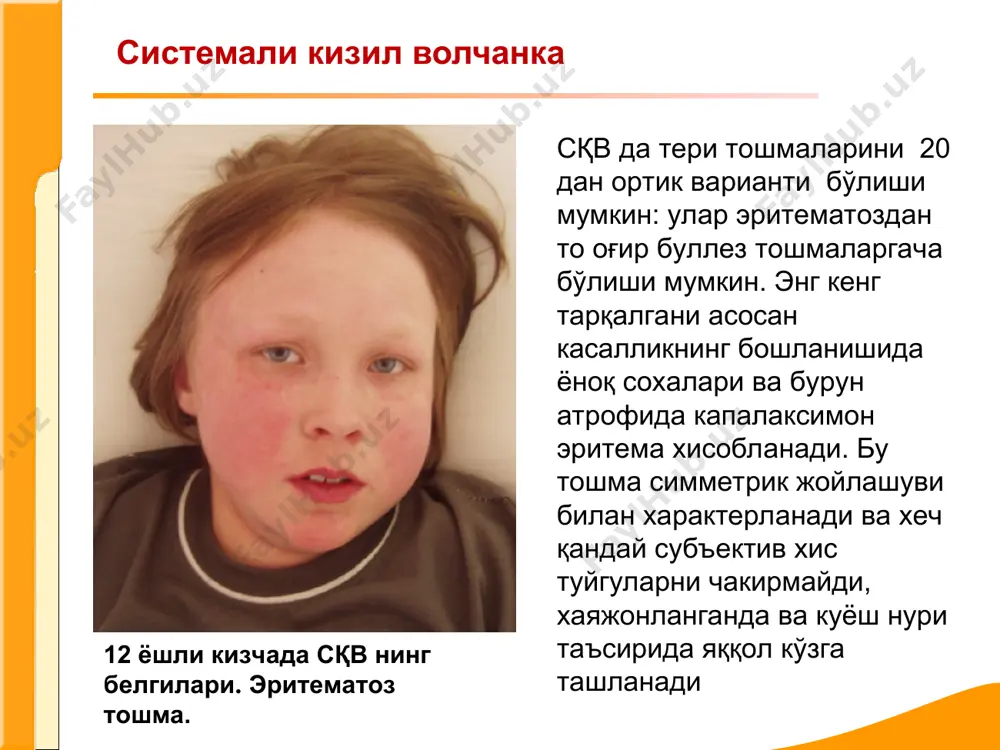 кўпинча терининг диффуз ёки ўчоқли гиперпигментацияси , терининг қуруқлашуви, гиперкератоз белгилари, трофик бузилишлар кузатилади. склеродактилия — кўл панжалари терисининг таранглашуви, харакатларнинг чегараланганлиги контрактуралар бўлиши каби кўрсаткичлар ва юз ифодасининг ниқобсимон бўлиши беморни кўздан кечиришнинг ўзидаёқ унга ташхис кўйишга имкон бериши мумкин. системали склеродермия биринчи ўринда бўғимлар синдроми юзага чиқади хамда у касалликнинг илк белгиларидан бири хисобланади. шунинг учун бу белги ссднинг эрта диагностикасида мухим кўрсаткич бўла олади. полиартралгиялар,узига хос полиартритлар намоён бўлиши мумкин. системали склеродермия системали склеродермия юмшоқ тўқималар кальцинози хусусан бармоқларда, периартикуляр сохаларда (синдром тибьержа-вейссенбаха)ссднинг клиник ва рентгенологик диагностикасида мухим кўрсаткич бўла олади. юмшоқ тўқималар кальцинози crest синдромининг бир қисми хисобланиб, ссднинг сурункали типи ва терининг чегарали шикастланиши рейно синдроми, қизилунгач шикастланиши, склеродактилия,телеангиэктазия билан бирга намоён бўлади. системали склеродермия оғиз атрофидаги вертикал бурмалар. юз ва бармоқлар томирлари кенгайган. бармоқлар териси таранглашган ва зичлашган, асосан бундай беморларда рейно синдроми кузатилади. ревматоид артрит ревматоид артрит — асосан бўғимларнинг сурункали яллиғланиши билан …