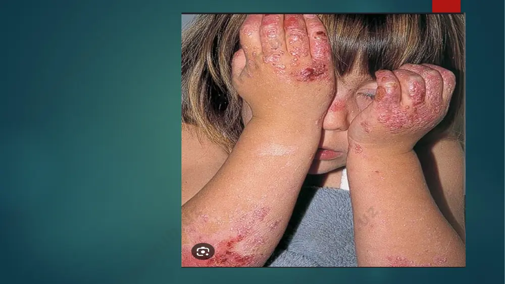 bullyoz dermatozlar differensial diagnostikasi.dyuringni dermatozi. pemfigus. - Page 3