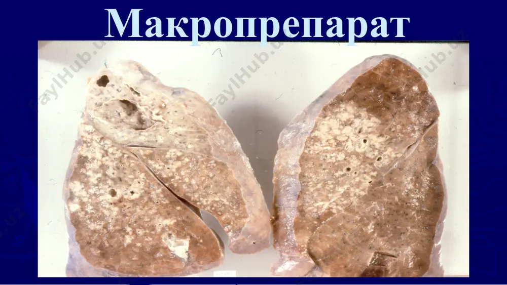 ўпканинг кавернали, фиброз-кавернали ва цирротик туберкулези - Page 5
