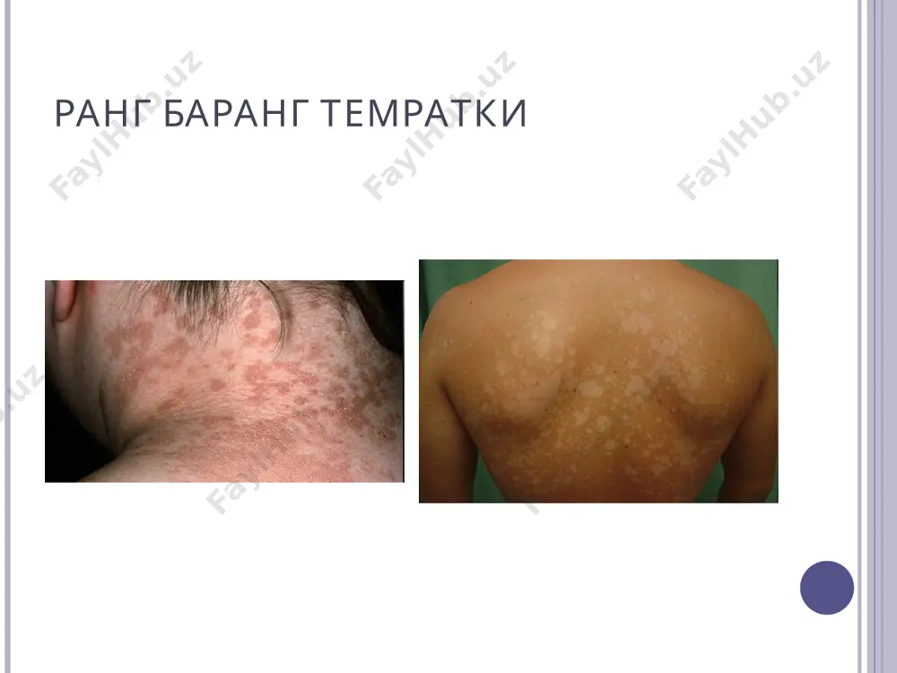 s var. gipseum касаллик манбаи –трихофитияга чалинган шахслар ва хайвонлар юкиш йуллари – беъмор билан беъвосита контактда булиш,еки зарарланган буюмлар оркали клиника юза турида –куп микдорда учоклар , чегараси ноаник, сочлар 2-3мм булинади чукур турида – яримшарсимон еки ясси кизил куимтир тусли тугунлар пайдо булади. яллигланиш аъломатлари аник, йирингли боскичи кузатилади. характерли белги – « kerion celsi » диагноз-клиник манзара,культурал текширувлар . дифференциал диагноз- микроспория, пиодермия, псориаз силлиқ тери юза трихофитияси инфильтратив-йирингли трихофития инфильтратив-йирингли трихофития трихофития трихофития лечение умумий терапия фунгицид воситаалр схема буйича ( систем антимикотиклар -гризеофульвин, дифлюкан, ламизил, низорал, леворин , орунгал) махаллий терапия -5% йодаэритмаси , 10% олтин гугурт , 3% салицил, 5%ихтиол, 5% серно-дегтярная, вилькинсон малхамлари . махсус малхамлар - батрифен, микоспор, кандибене, клотримазол, ламизил, микосептин, миконазол, низорал ит.д. кал-фавус фавус – кам учрайдиган, камконтагиозли дерматофития , сочлар, ясси тер, тирноклар, ички аъзолар шикастланади. кузгатувчи –антропофил замбуруг trichophyton shonleini таснифи типик( скутуляр тури) атипик-сквамоз ва импетигиноз …