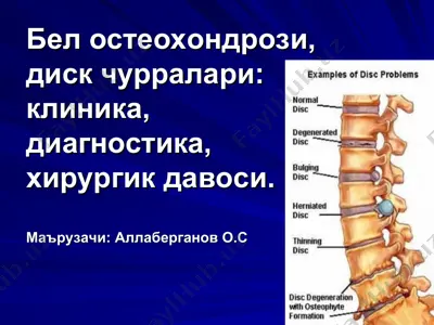 бел остеохондрози, диск чурралари: клиника, диагностика, хирургик давоси — PPT