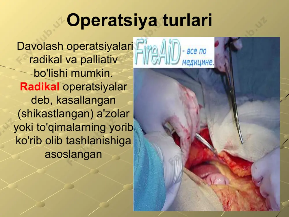 faqat kesish o'tkaziladigan joygina ochiq qoldiriladi. operatsiya maydonini chegaralash uchun katta-kichik choyshablar, sochiqlar va salfetkalar ishlatilad 3. og'riqsizlantirish. operatsiyalarda, shu jumladan ambulatoriyalarda ham ko'pincha kam hajmli mahalliy anesteziya qo'llaniladi va uning yordamida jarrohlik yo'li bilan davo qilinadigan joydagi tegishli asab reseptorlarining sezuvchanligini yo'qotishga erishiladi. og'riqsizlantirish uchun novokain, selnovokain va lidokaindan foydalaniladi. hozirgi paytda umumiy og'riqsizlantiruvchi narkoz keng qo'llaniladi 4.operatsiyani amalga oshirish operatsiya vaqtida patologik o'choqqa yoki kasallangan a'zoga jarrohlik yo'li bilan davo qilinadi. masalan, abssess yorib ko'riladi, ochiq arterial tomir bog'lanadi, o't pufagi olib tashlanadi. operatsiya vaqtida ishlarni tashkil etish xirurgik operatsiya faqat maxsus jihozlangan operatsiya zalida yoki bog'lov xonasida o'lkaziladi. xirurgik operatsiyani operatsiya qiluvchi xirurg, assistent xirurglar, operatsiya hamshirasi, sanitarkalar va narkoz ishlatiladigan hollarda vrach-anesteziolog hamda anestezist hamshiralar amalga oshiradilar. 5. terini tikish bosqichlari operatsiyadan keyingi davr 1) dastlabki faza - operatsiyadan keyingi dastlabki 3-5 kunni o'z ichiga oladi; 2) kechki faza - operatsiyadan keyingi 2-3 haftadan iborat, ko'pincha …