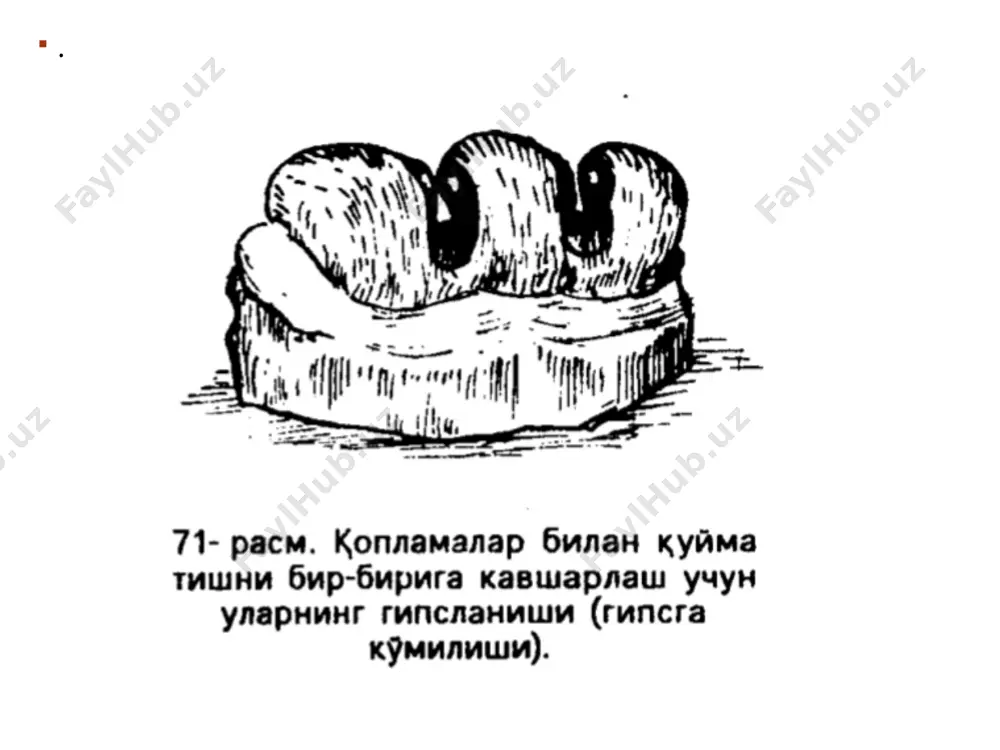 нинг ич тарафидан шу ерига бура солиниб спиртли идиш ёрдамида ёки бош^а алангада «¡опламанинг буйин тарафи тепага ^аратилиб, пинцет билан ушлаб ^издирилади. бура цоплама ичида эриб текислангач устига олтин кавшардан цуйиб яна аланга устида бир оз ушлаб турилади. у эригач пинцетнинг тепа даетак тарафига секин чертилади. шунда кавшар цопламанинг чайнов ёки кесув тарафига о^иб тар^алади. сунг олтин ^оплама яна уз жойига моделга ^уйилади. агар ^опламалар зангламайдиган пулатдан булса, моделдан чи^ариб олинган ^опламанинг тиш билан ёки бошца ^оплама билан кавшарланадиган ^исми кавшарнинг яхши ёпишиши учун ю^орида айтилганидек тупондан тозаланади (агар ^опламалар ичидаги мум эриганда моделдаги шу ^оплама турган гипели тишнинг буйин ^исмини кумиб юбориб ^опламани уз жойига утиришига хала^ит берадиган булса, мумни тозалаш керак) тозаланган ва тугриланган ^уйма тишни (ёки фасетка булса, унинг металл ^исмини) уз жойига — ^опламалар орасига куйиб ёпипщо^ мум билан ^опламаларга елимланади. к,опламалар билан елимланган тишларнинг тезро^ ^отиши учун улар совук сувга солиниб олинади ва оз^исталик билан …