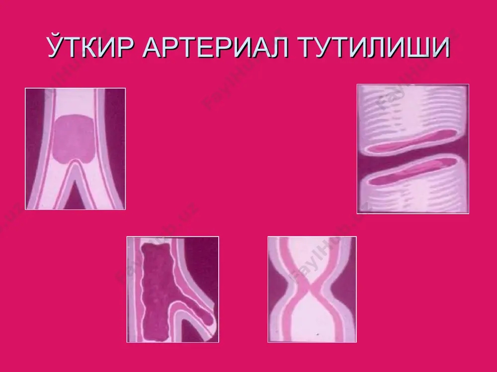 никланмайди. эмбол пульсация йук эмбол эмбол 6 – окклюзиядан пасда пульсация сезилиши мумкин.` окклюзия пульсации 6 - артериал спазм бартараф булганда эмбол артерияни дистал кисмига миграция килиши мумкин. эмбол диагнозни 100% аник куйиш мумкин: агар: - уат бирданига 40 ешли одамда булса - атеросклероз булмаса - ревматик нусон булса - мерцал аритмияси булса диагноз - эмболия. агар: - уат секин ривожланса - бемор еши улуг булса - утиб кетувчи оксокланиш булса - юрак касали булмаса - мерцал аритмияси булмаса диагноз - уткир тромбоз. дифференциал диагностика: уткир веноз тромбозлар сурункали критик ишемия облитерацияловчи эндартериит уткир кундаланг миелит радикулит уат ва аорта деворлари катламланиши умумий белгилари -огрик -сезги бузилиши -пульсацияни йуклиги -тери копламлари окиш рангда булиши -совкатиш уатнинг аорта деворлари катламланишидан фарки уткир артериал тутилиш аорта деворлари каватланиши огрик жуда кучли кучли огриклар огрик локализацияси оекларда елкададаги огриклар сезги бузилиши совкотиш сохасида сезги бузилади совкатиш сохасидан юкорида оеклар ишемияси кучли кучли эмас …