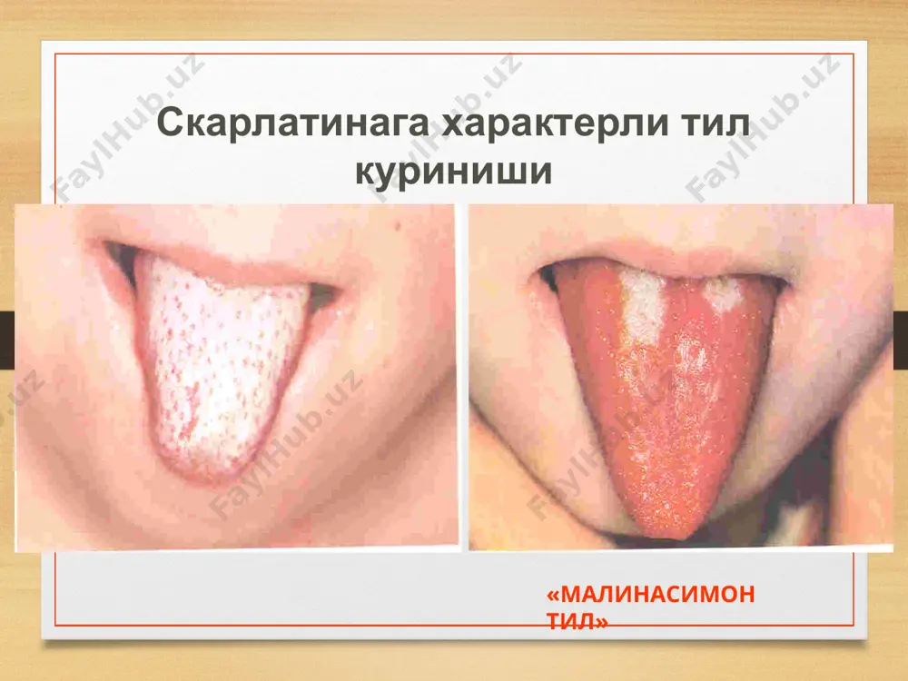 и шароит яратиб бўлмайди. шифохонадан чиқаришга касалликнинг килиник белгилари бартараф бўлгандан кейин ва асоратлари ҳамда бурун, томоқ йўлларидаги яллиғланиш жараёни йўқолгандан сўнггина рухсат этилади. profilaktikasi image7.png image8.png image9.png image10.png image11.png image12.png image13.png image14.png image15.png image3.png image4.png
